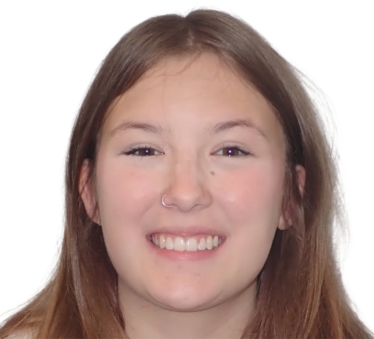 After orthodontic treatment - Case 21