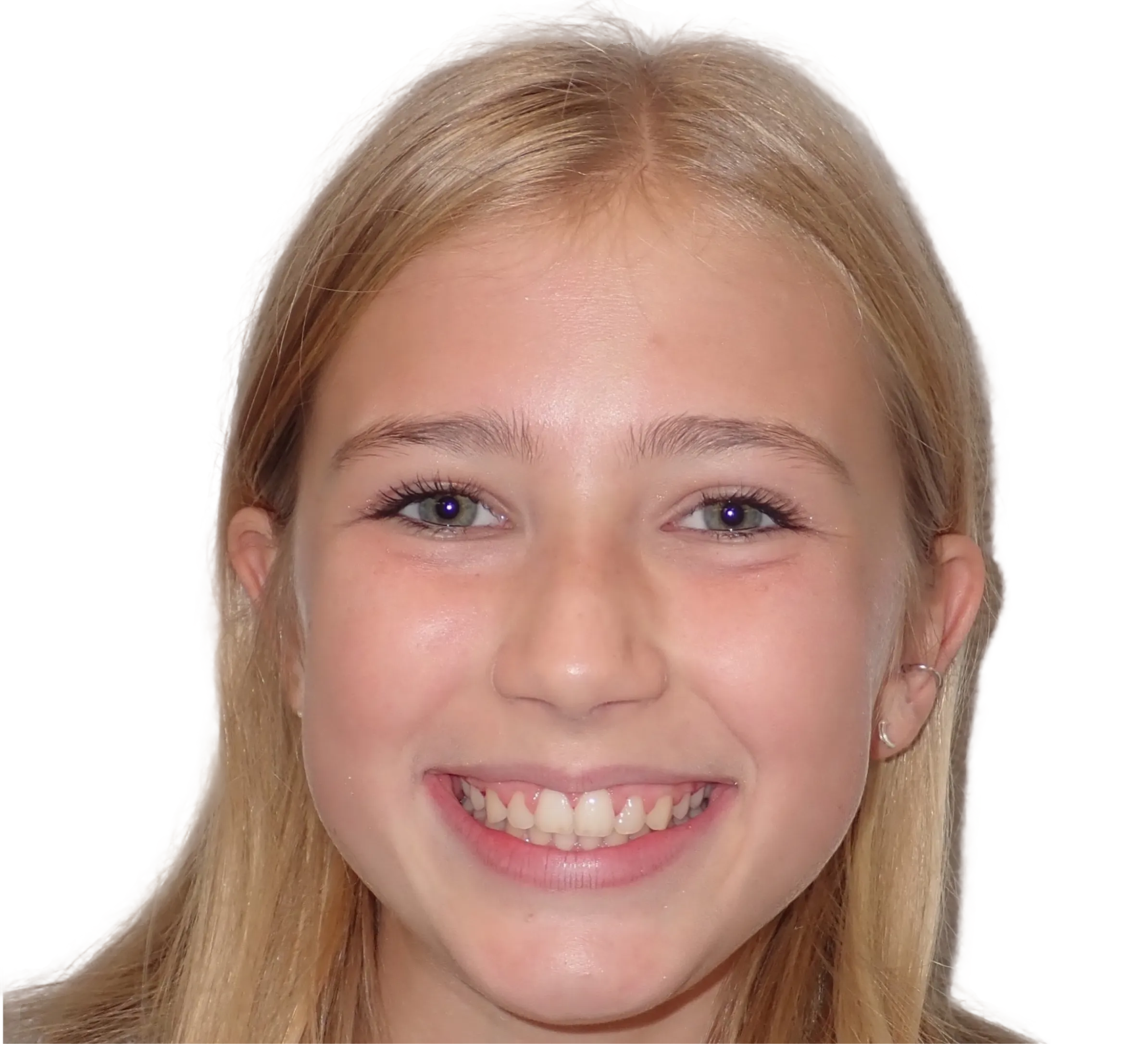 After orthodontic treatment - Case 22