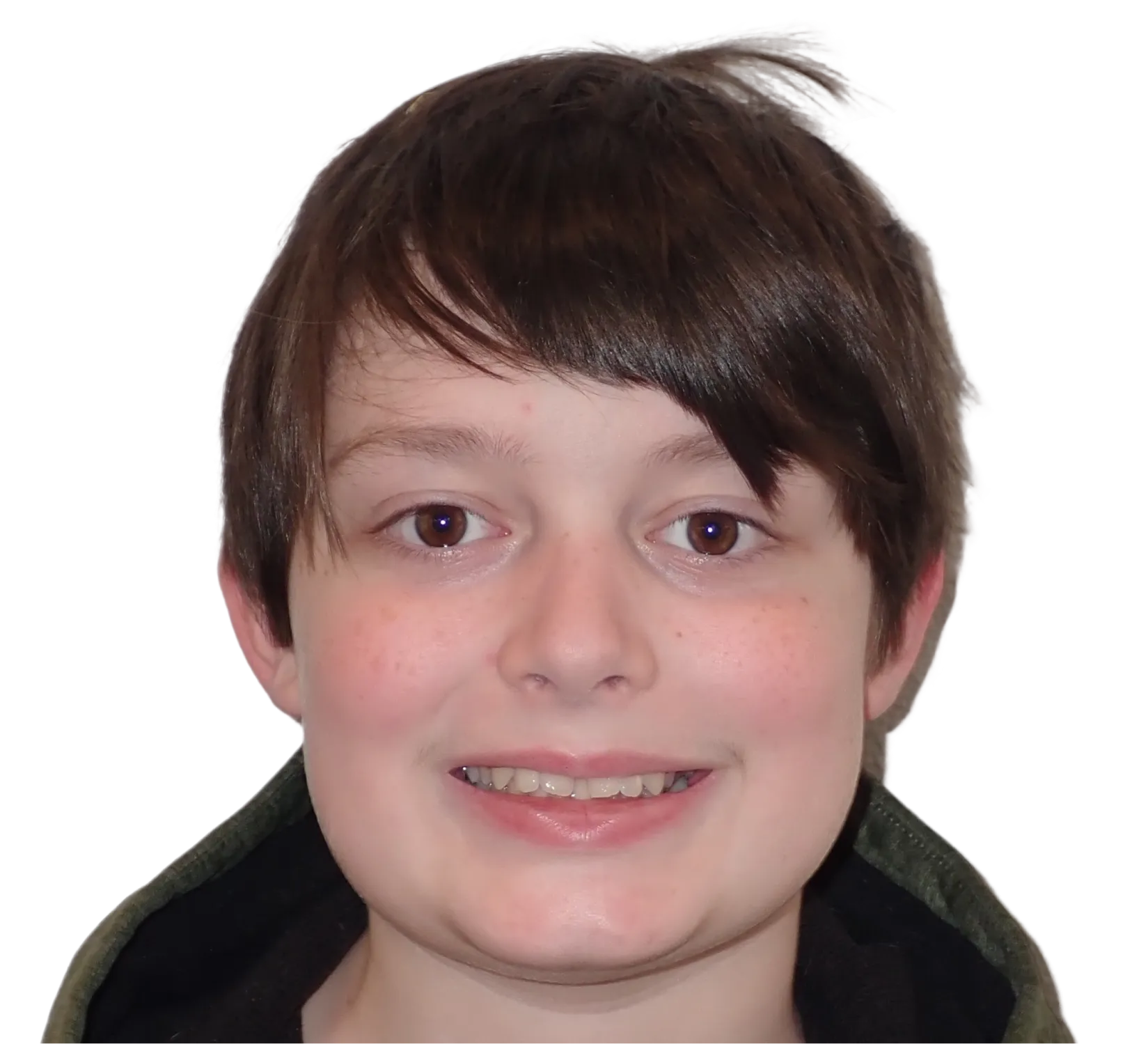 Before orthodontic treatment - Case 23