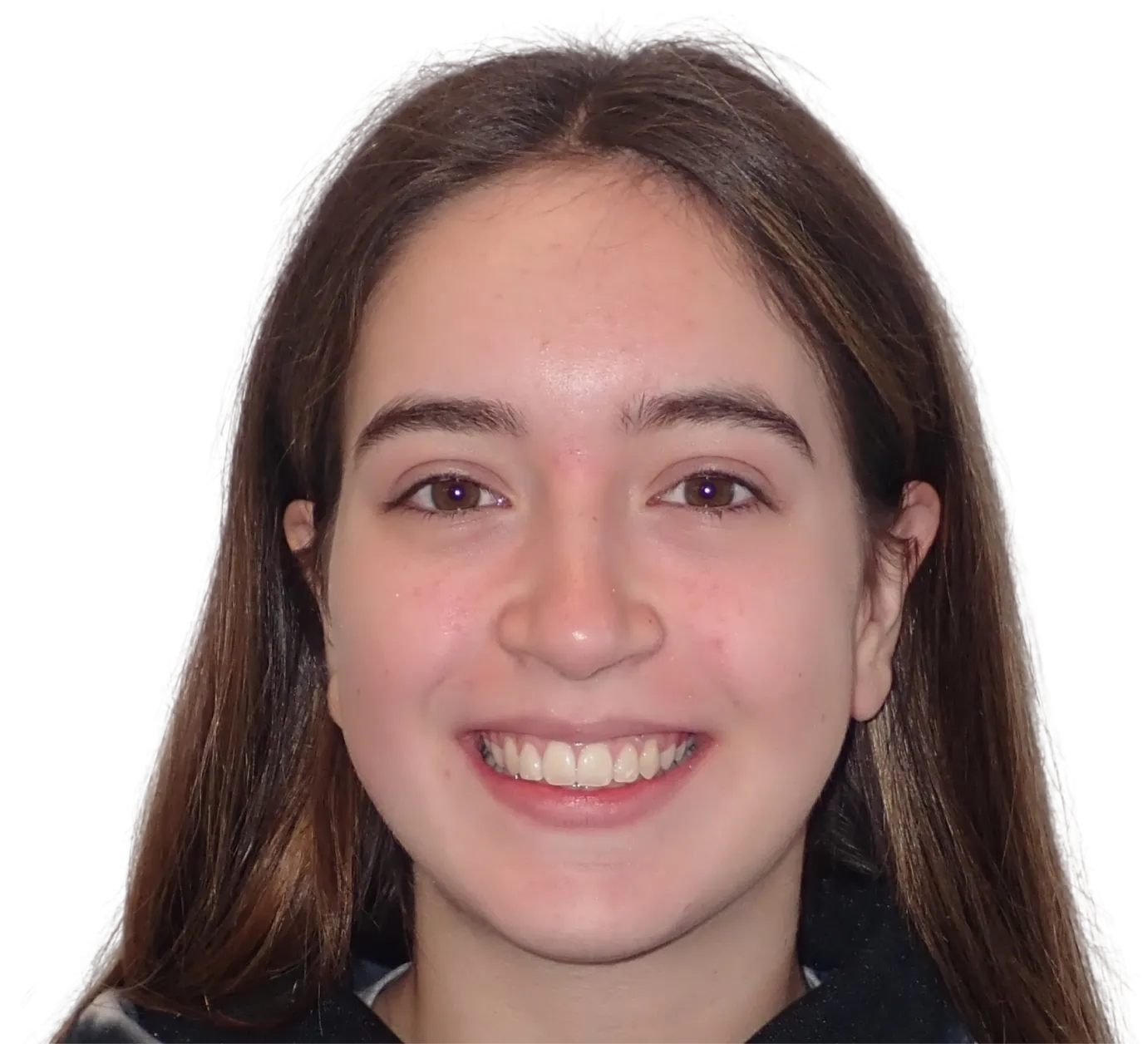 After orthodontic treatment - Case 24