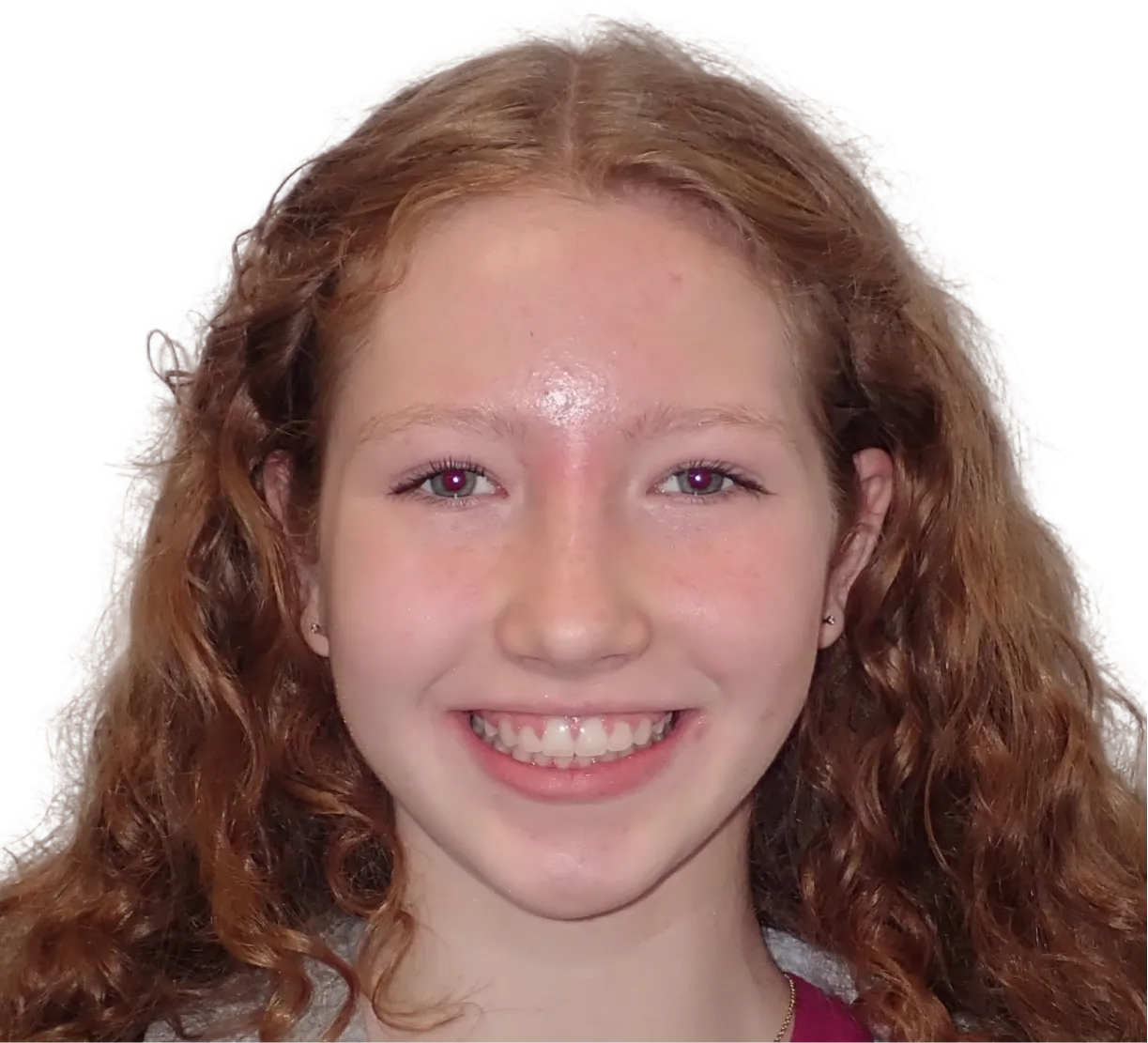 After orthodontic treatment - Case 25