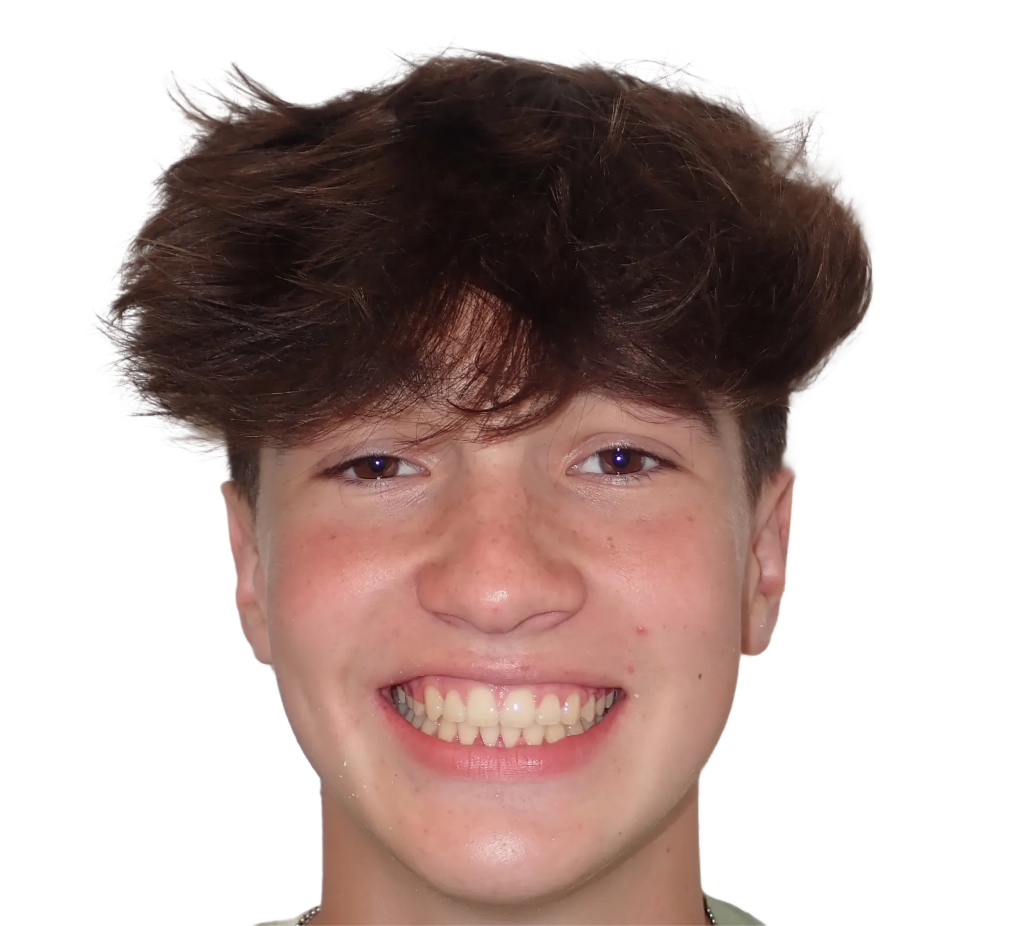 After orthodontic treatment - Case 27