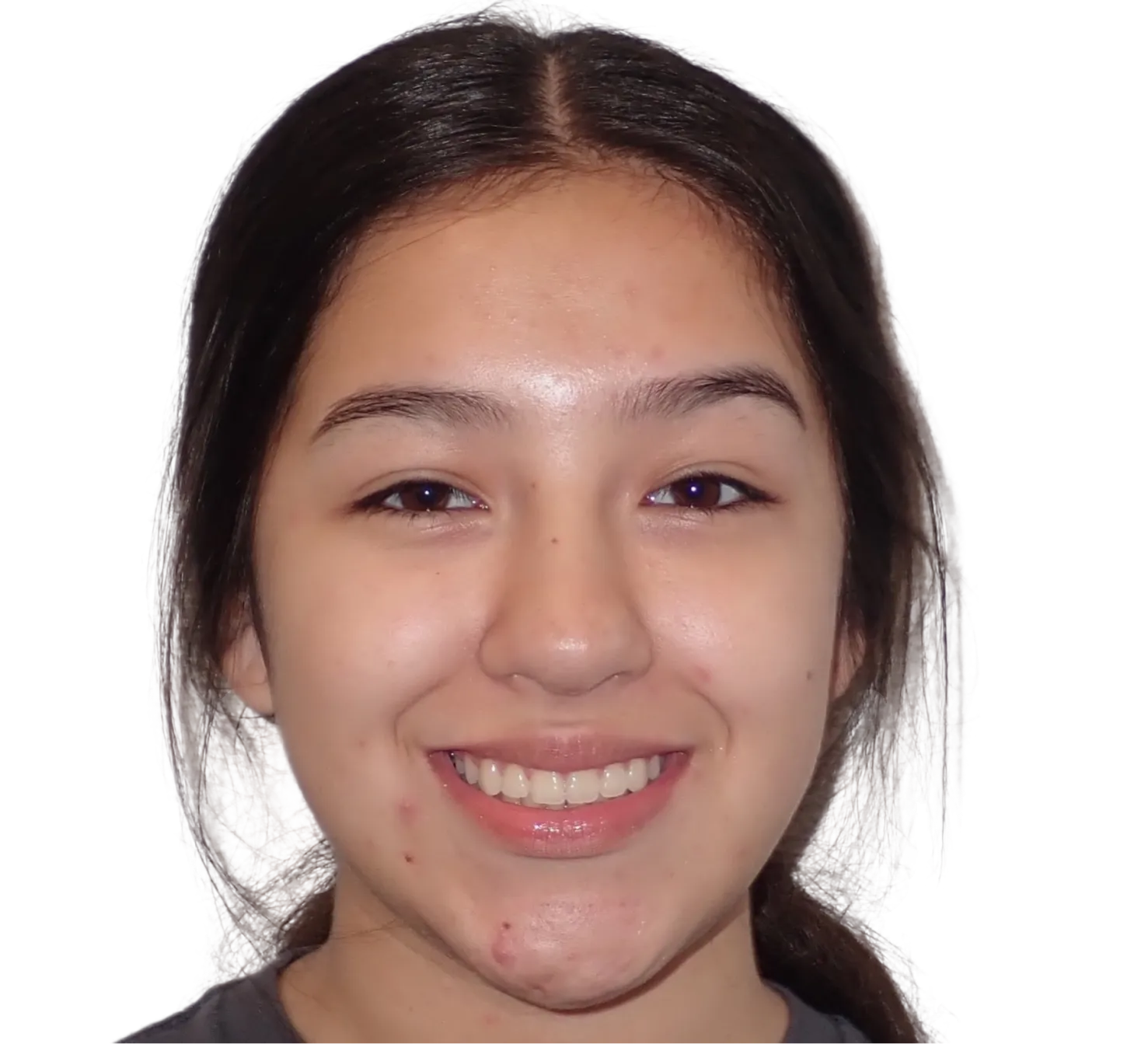 After orthodontic treatment - Case 28