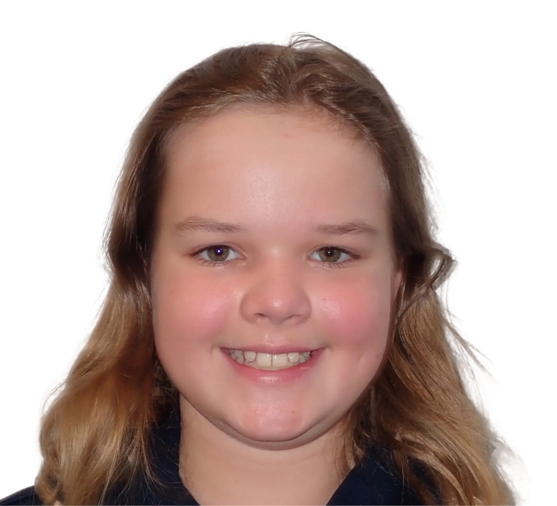 Before orthodontic treatment - Case 32