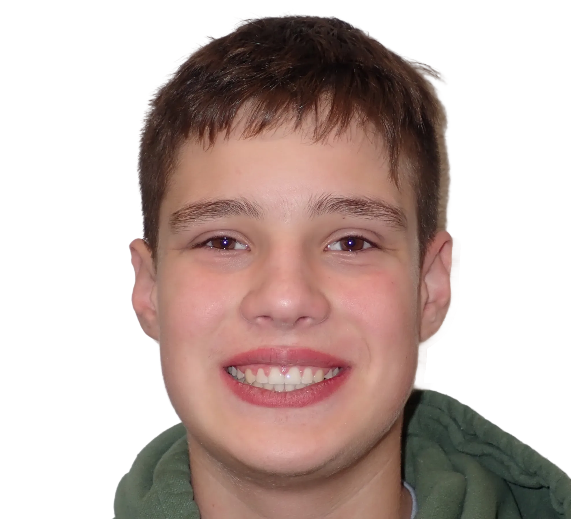 After orthodontic treatment - Case 35