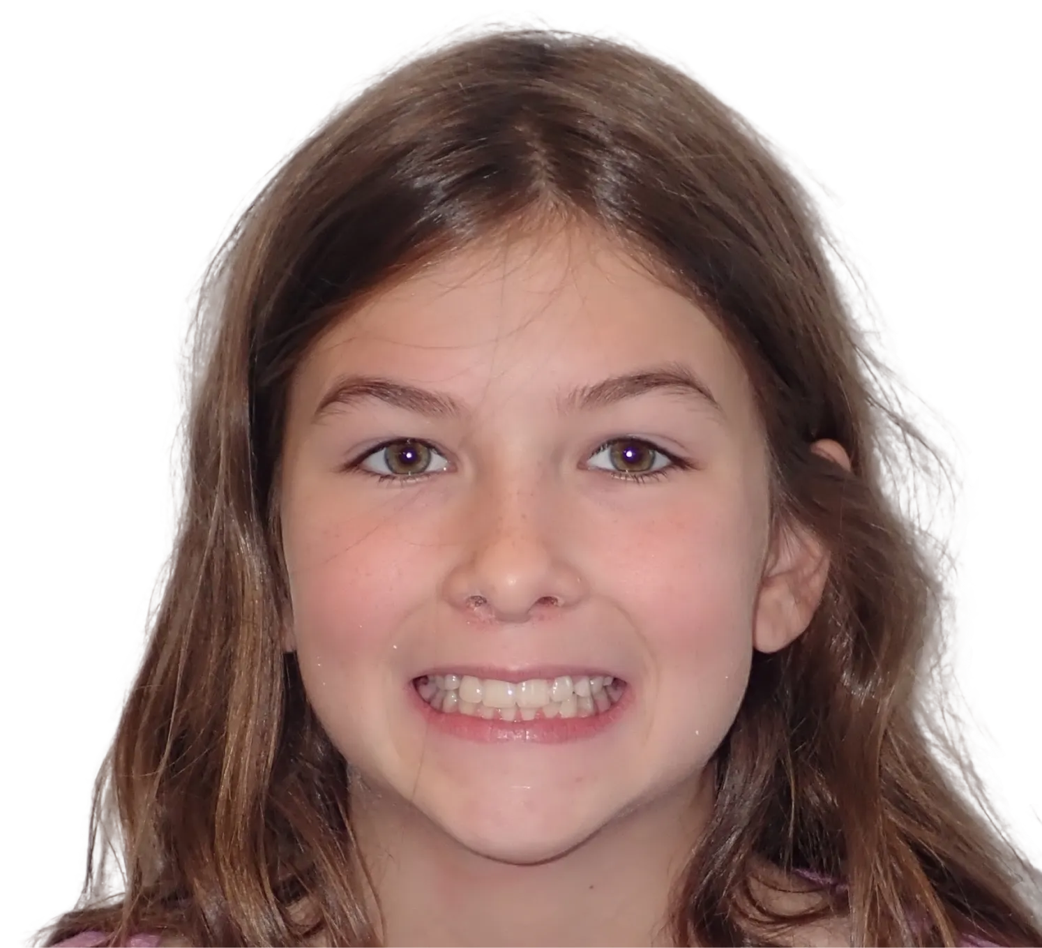 After orthodontic treatment - Case 37
