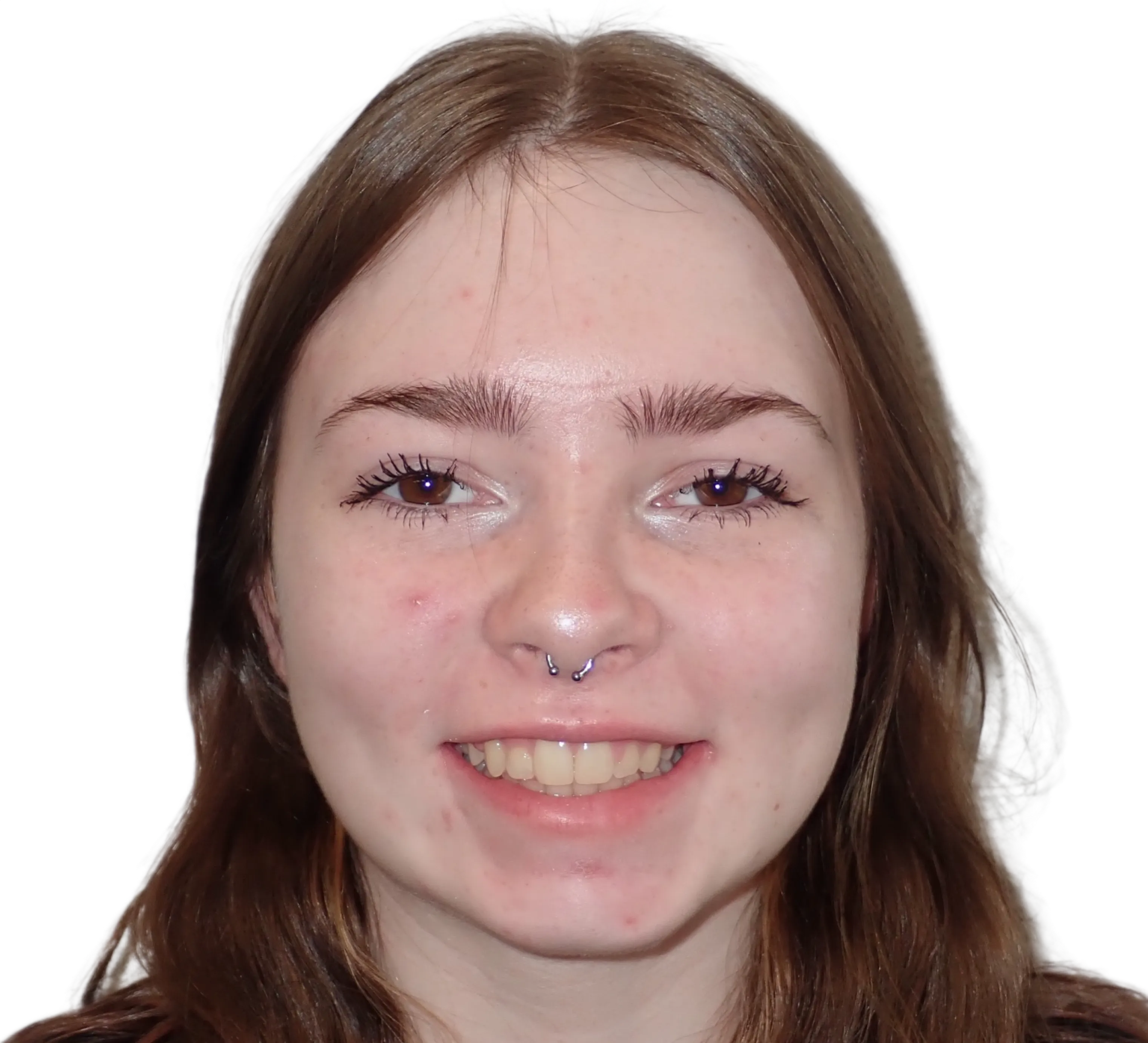 After orthodontic treatment - Case 40