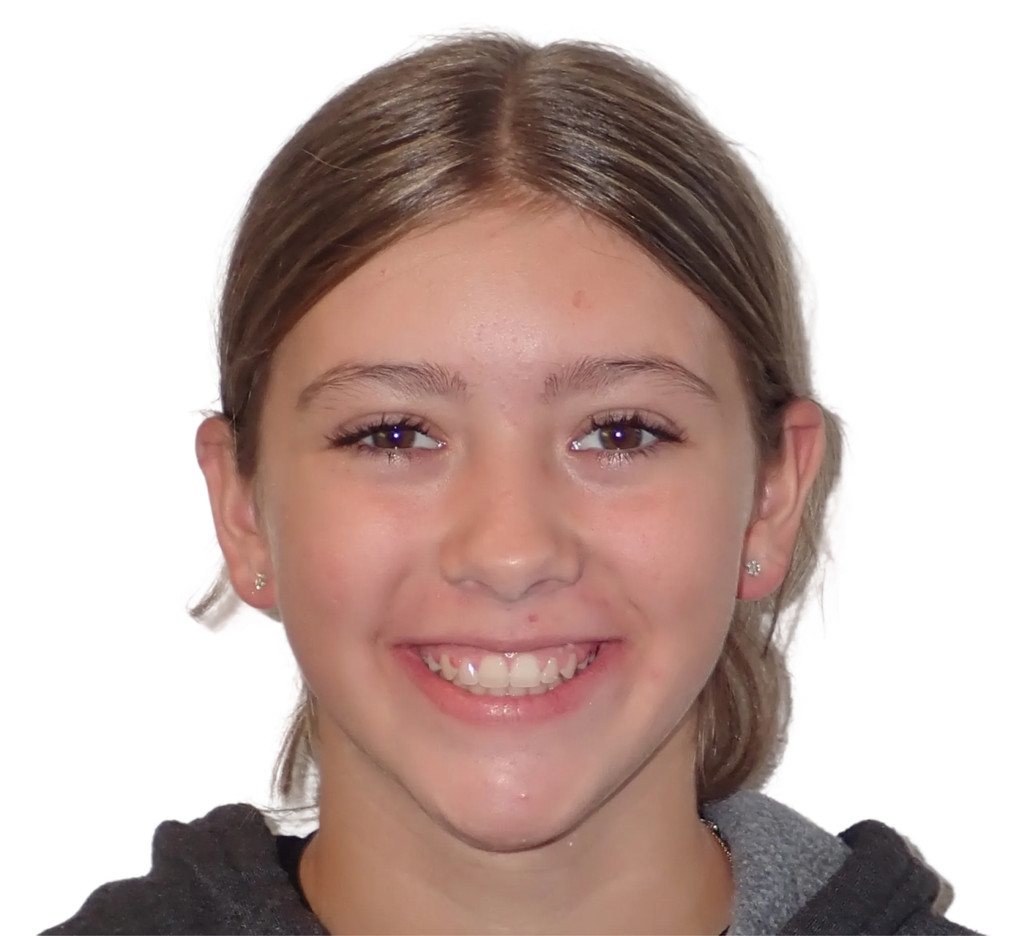 After orthodontic treatment - Case 44