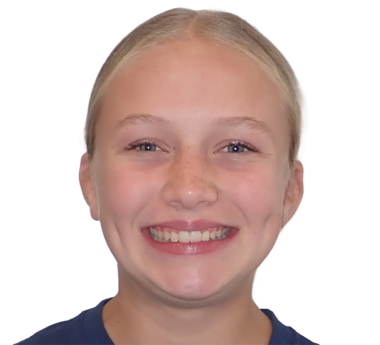 After orthodontic treatment - Case 45