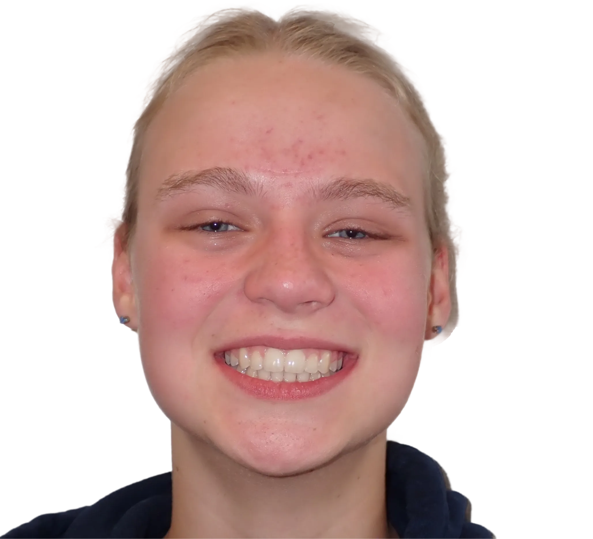 After orthodontic treatment - Case 52