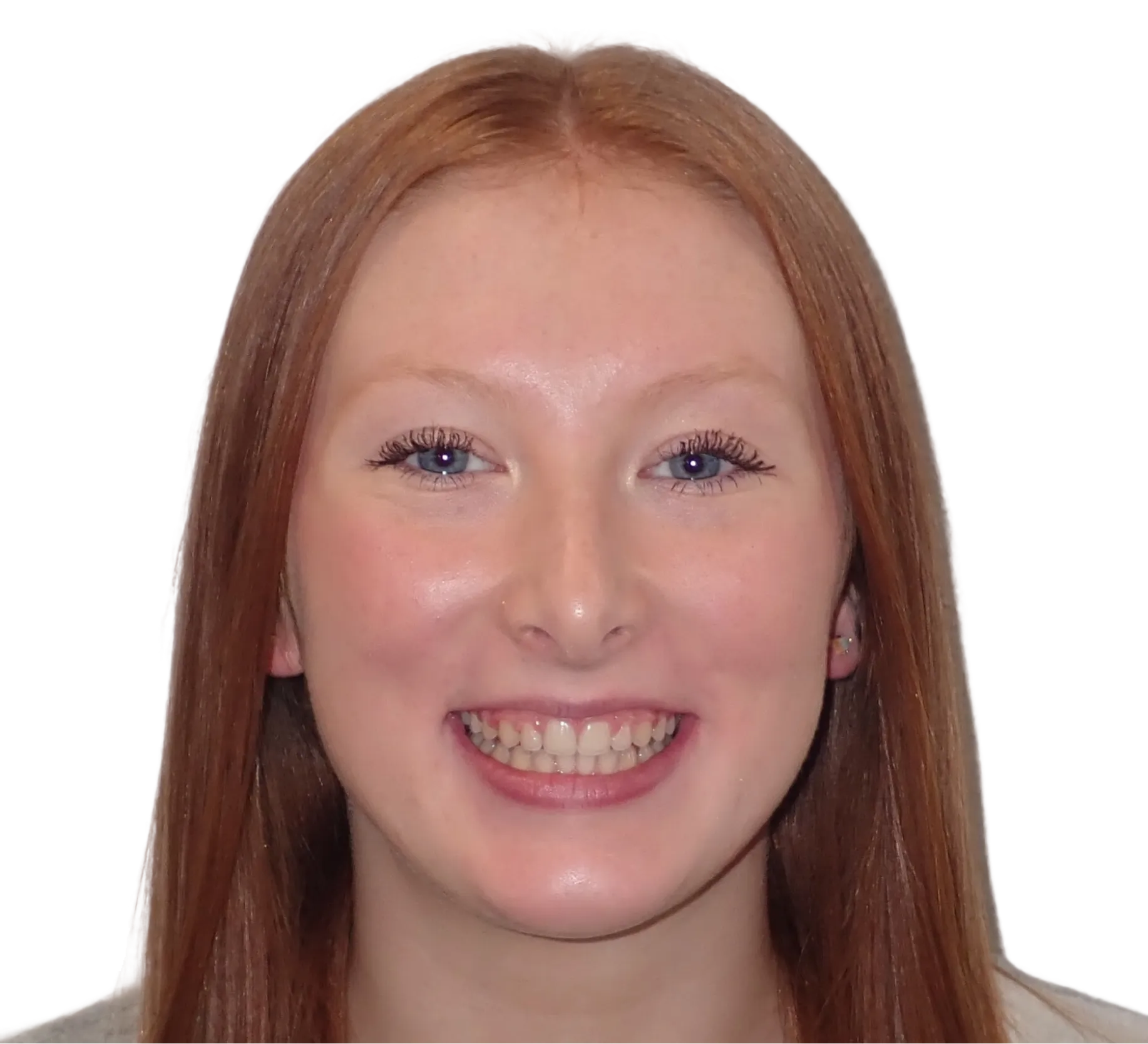 After orthodontic treatment - Case 53