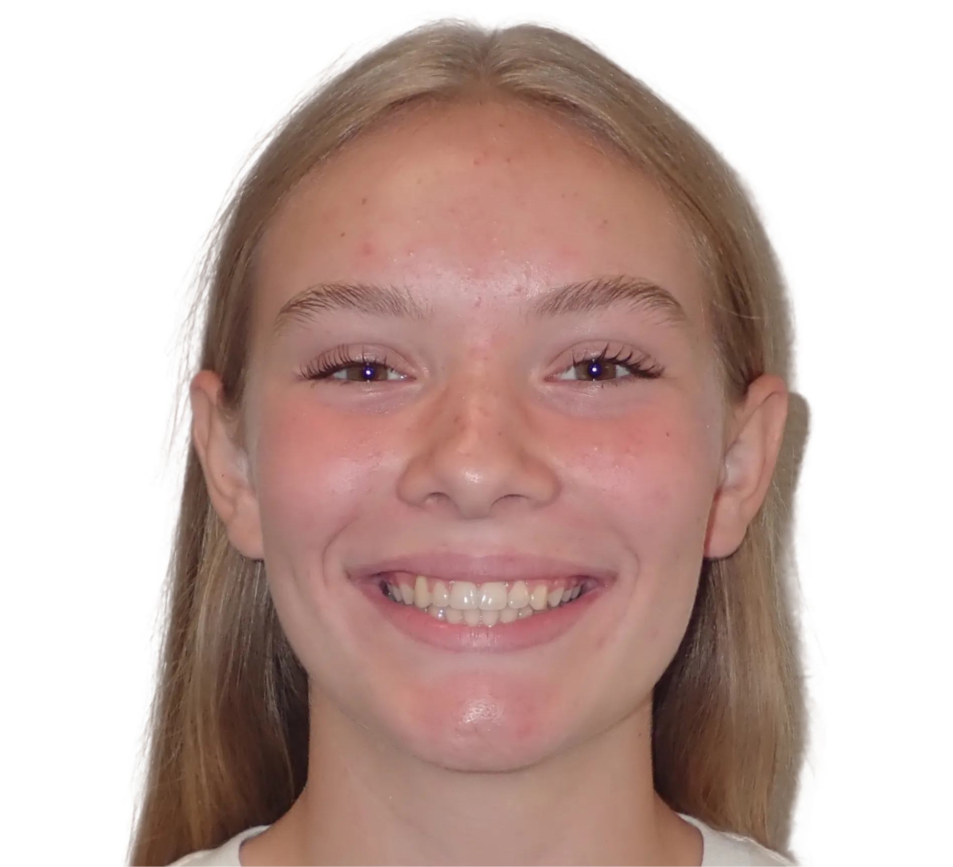 After orthodontic treatment - Case 54