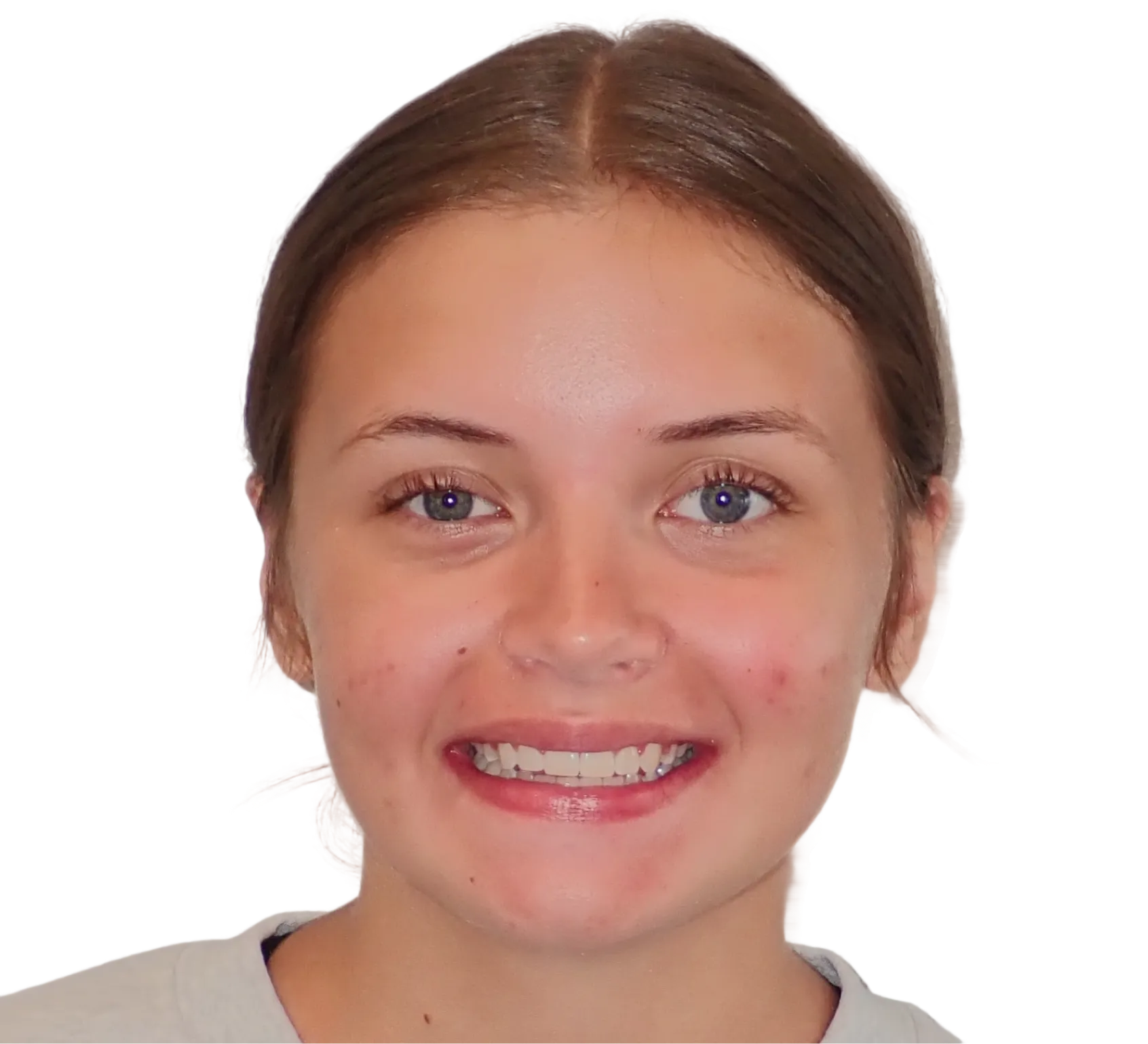 After orthodontic treatment - Case 55