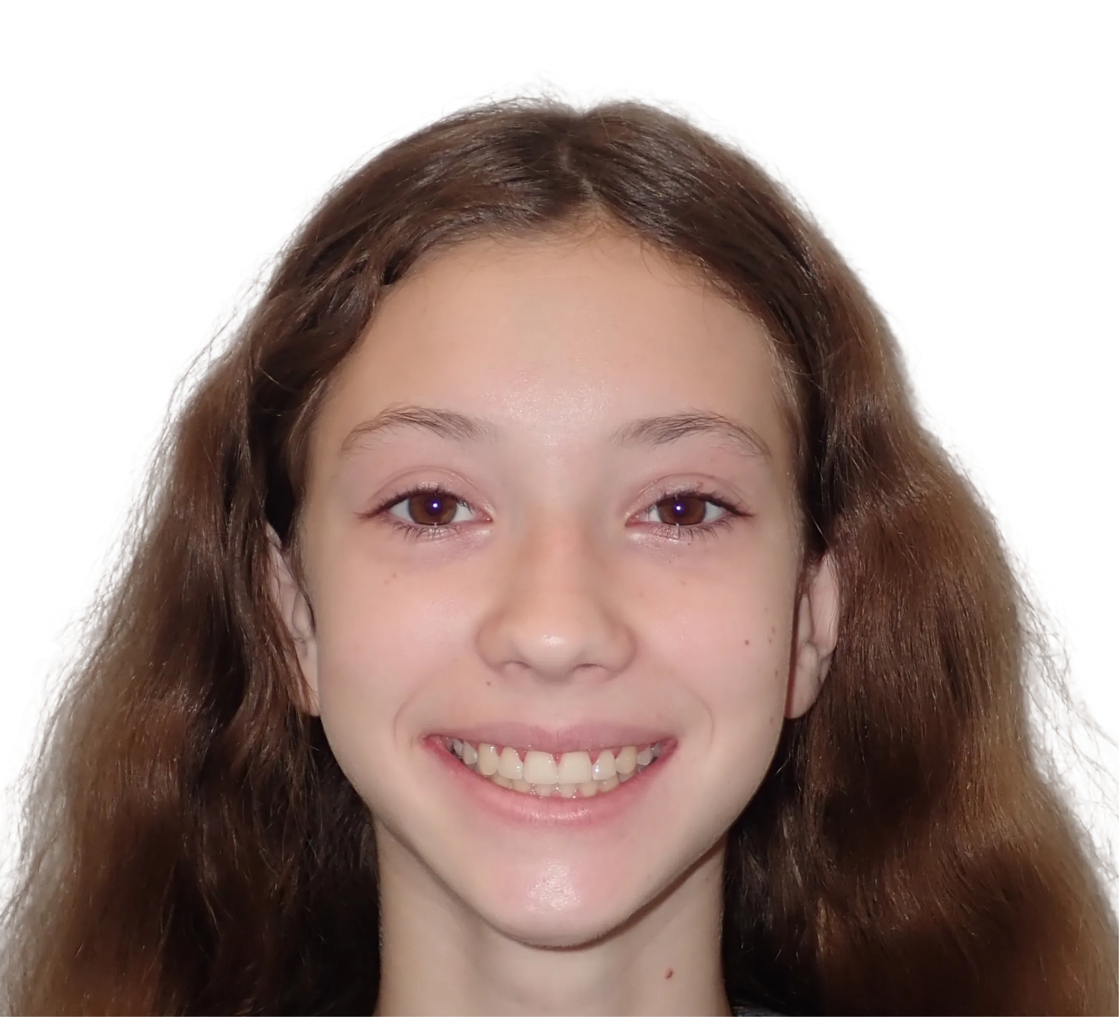 After orthodontic treatment - Case 57