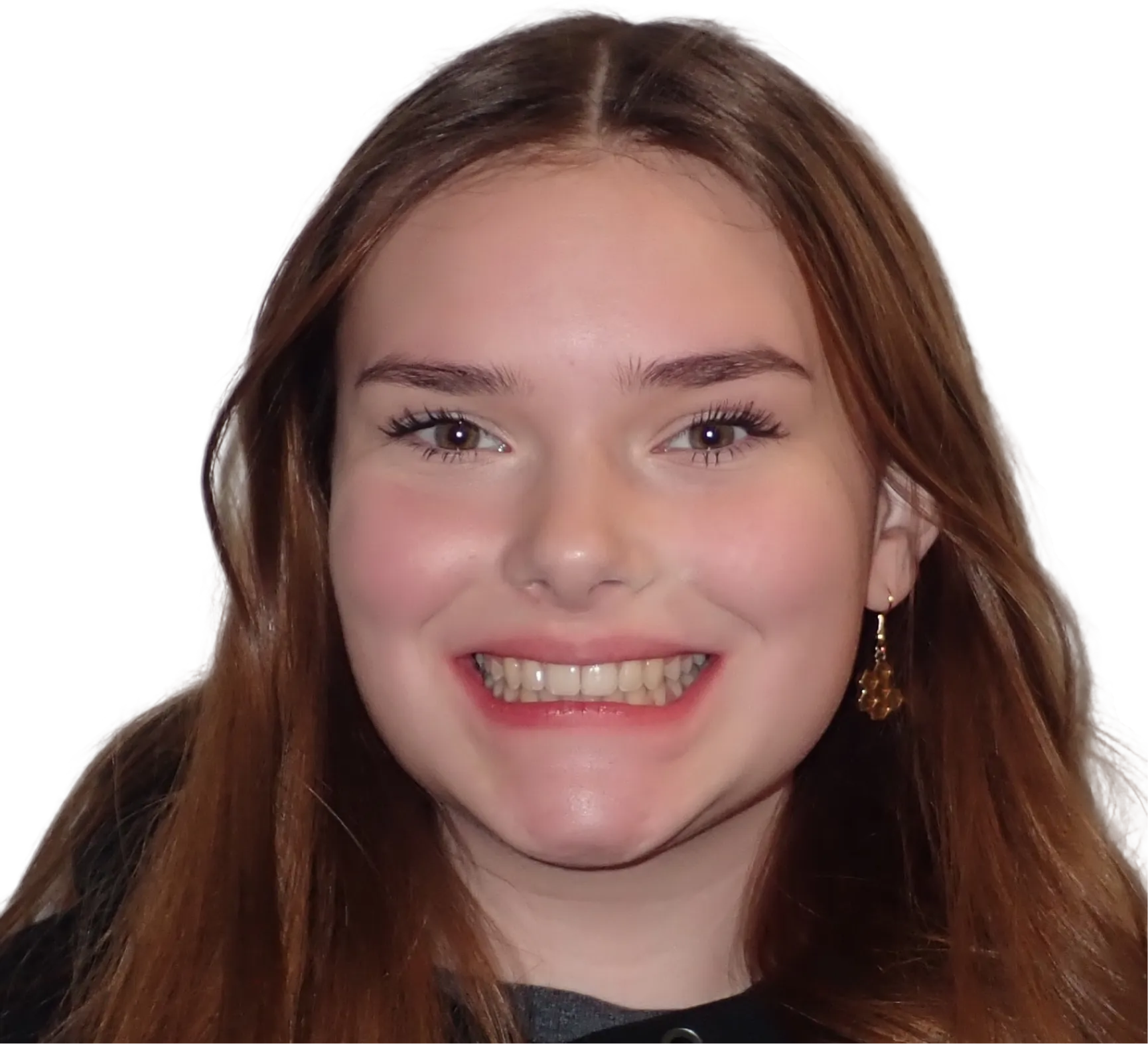 After orthodontic treatment - Case 58