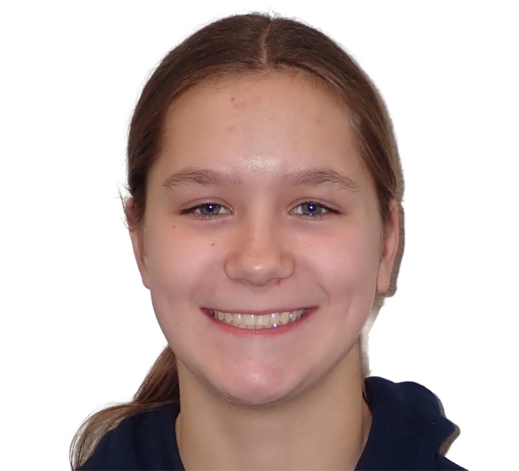 After orthodontic treatment - Case 61
