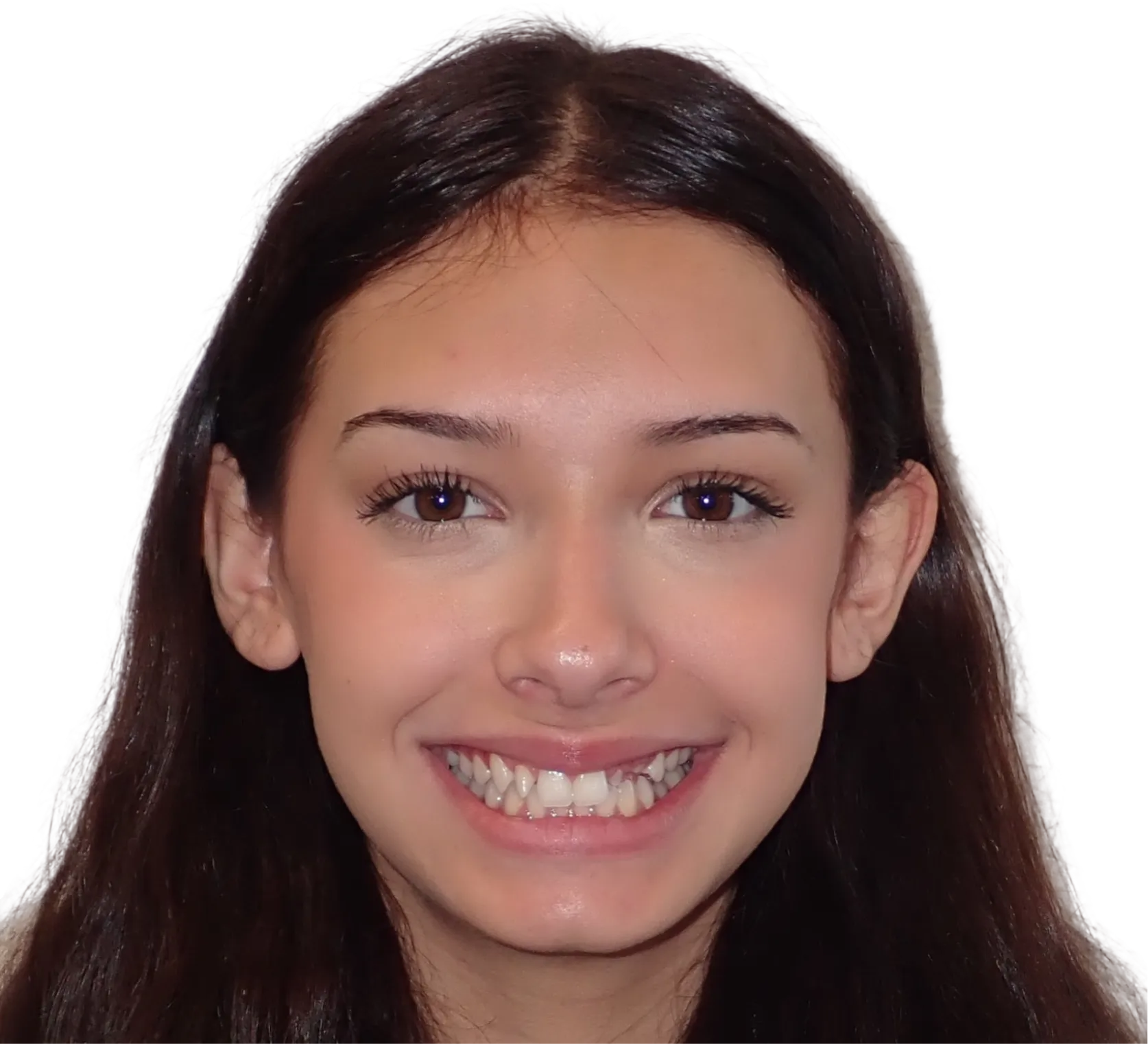 Before orthodontic treatment - Case 62