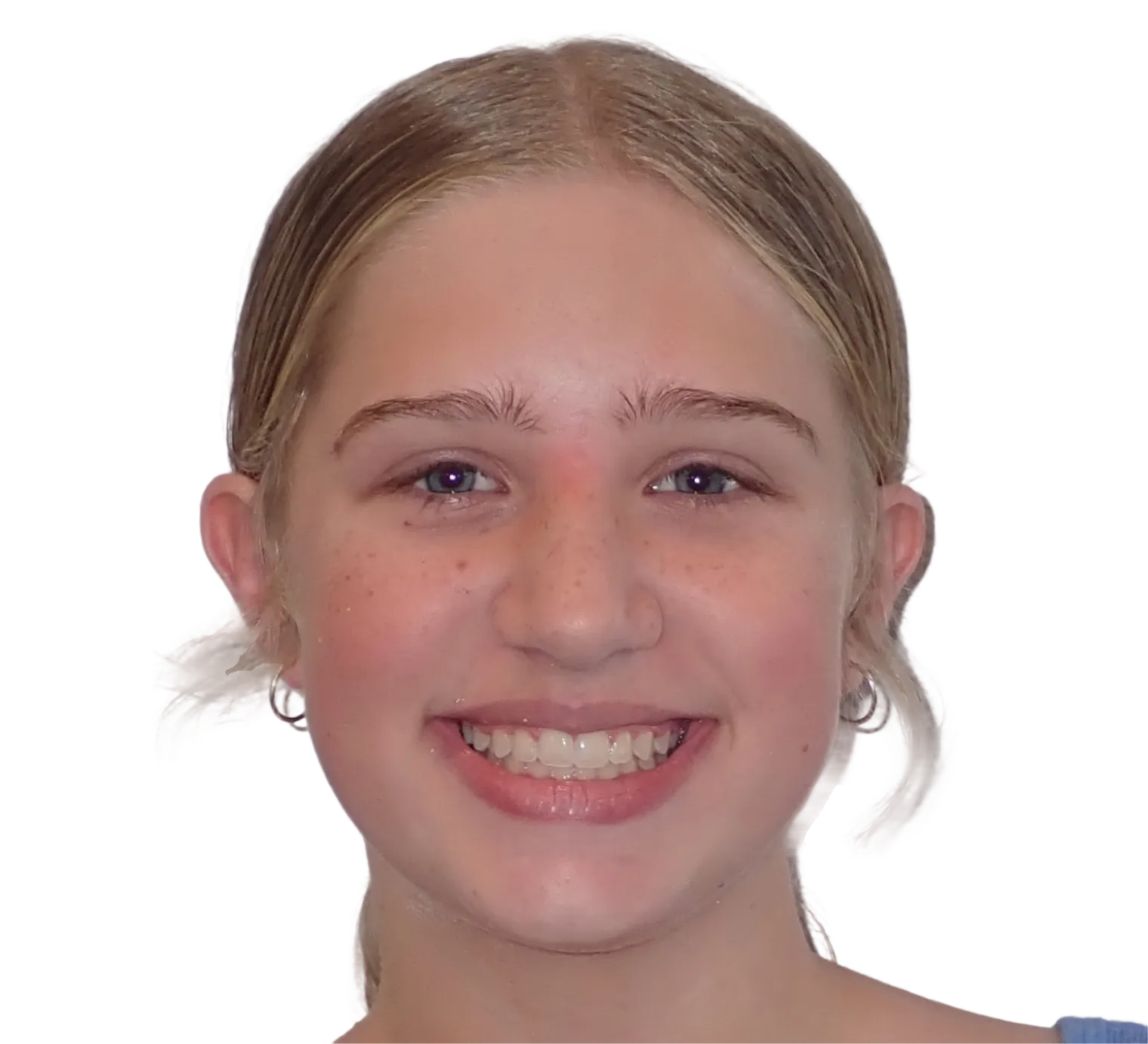 After orthodontic treatment - Case 63
