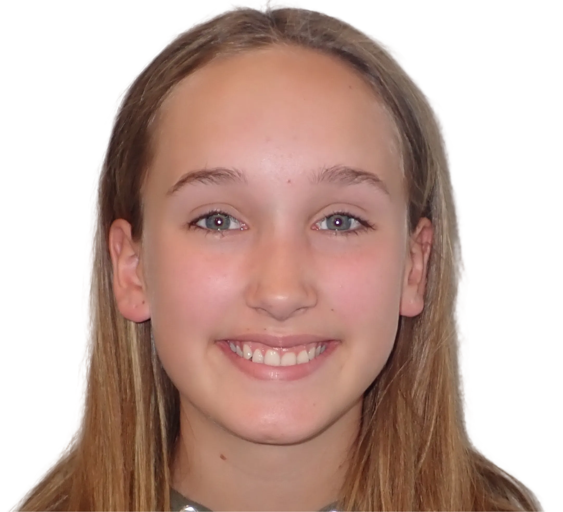 Before orthodontic treatment - Case 18