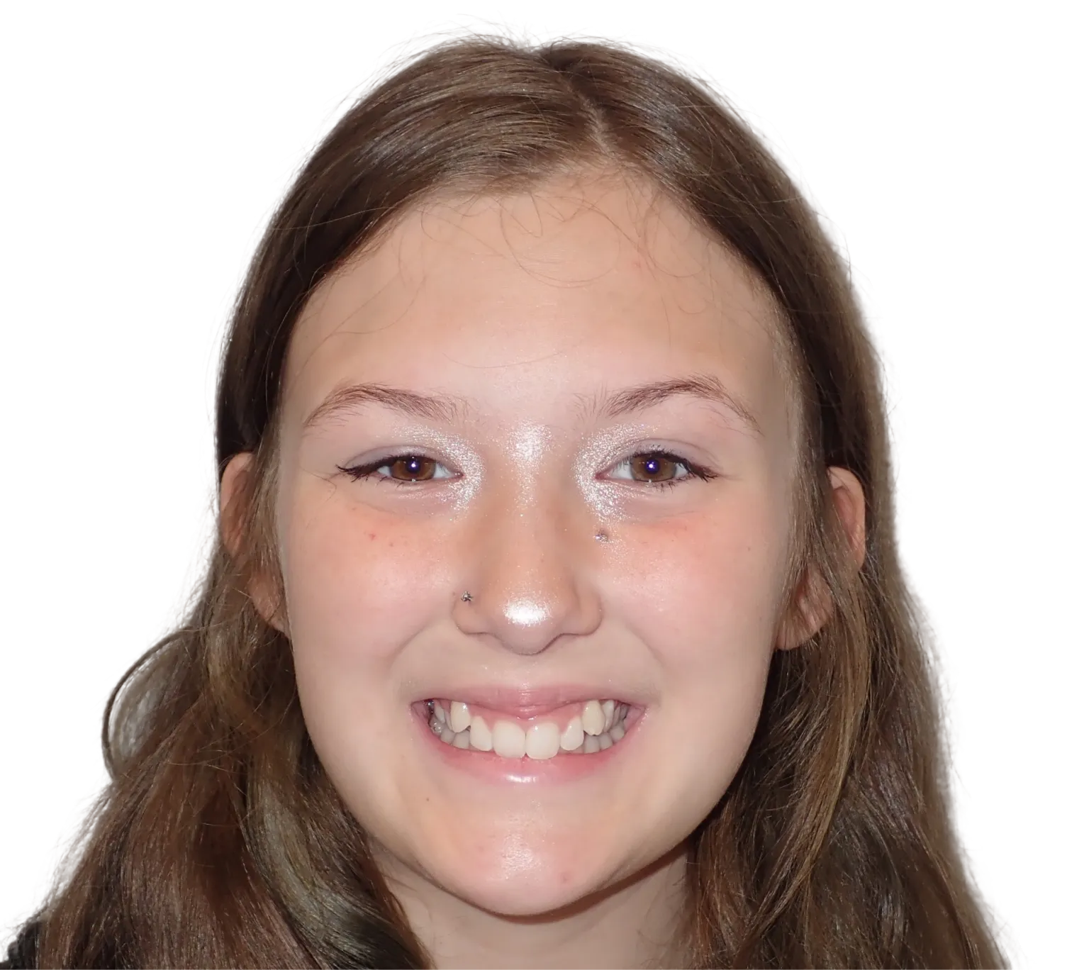 Before orthodontic treatment - Case 21