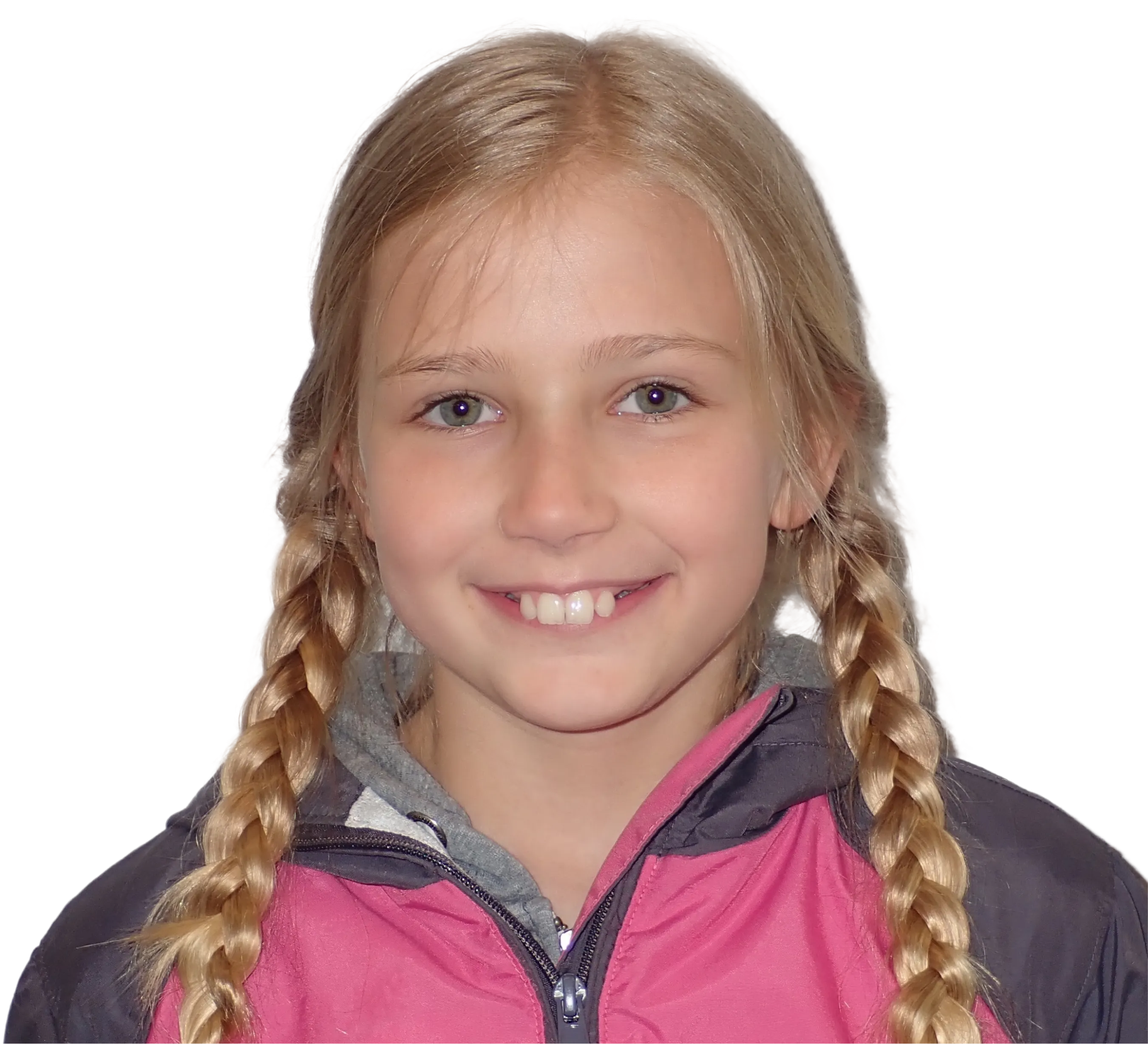 Before orthodontic treatment - Case 22
