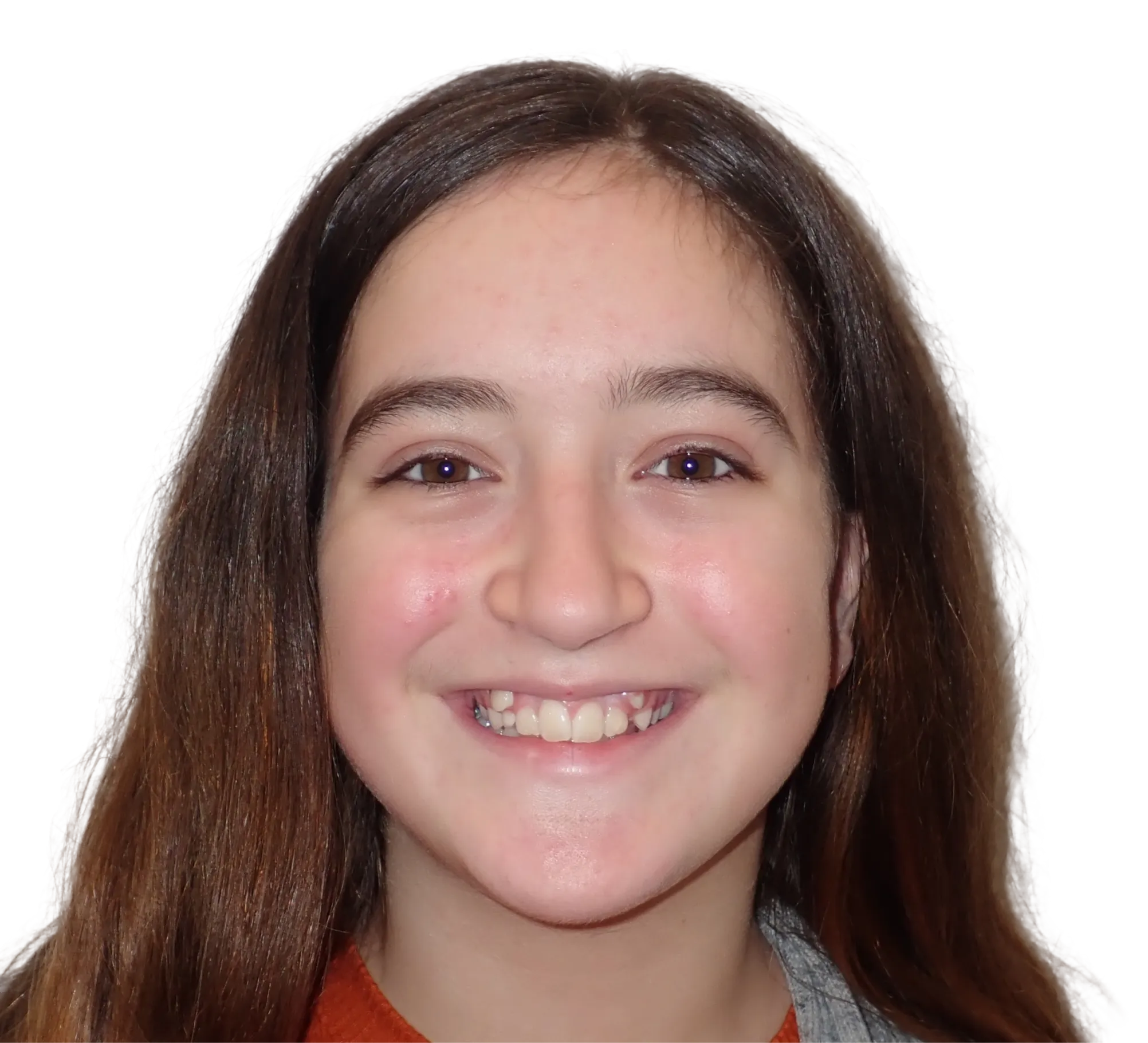 Before orthodontic treatment - Case 24