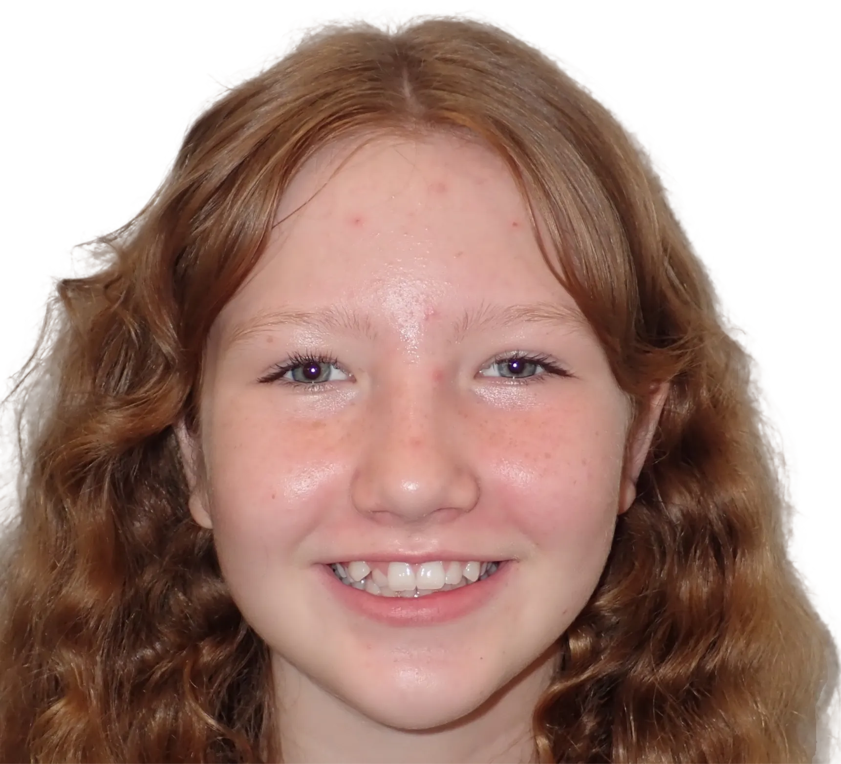 Before orthodontic treatment - Case 25