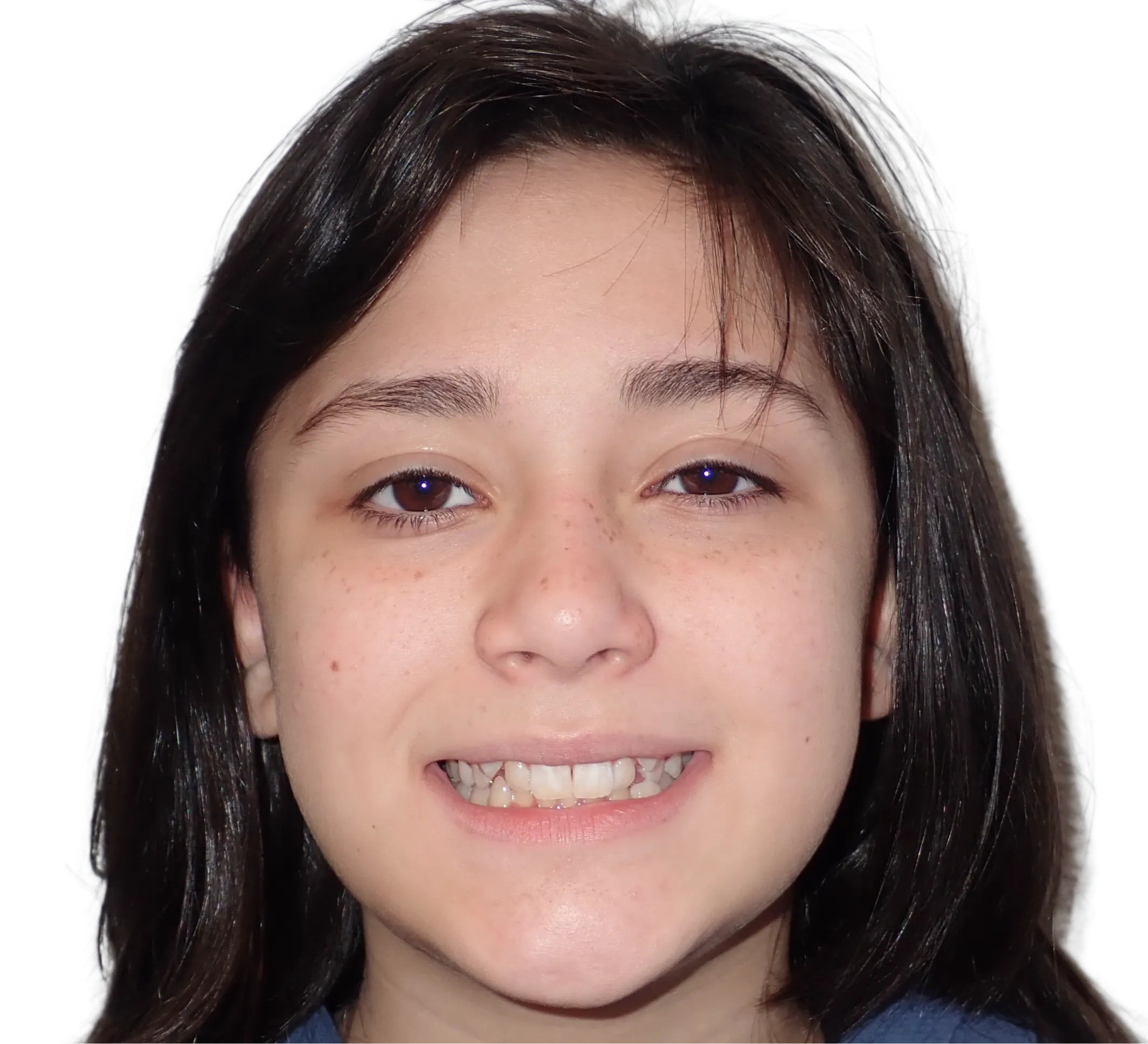 Before orthodontic treatment - Case 26