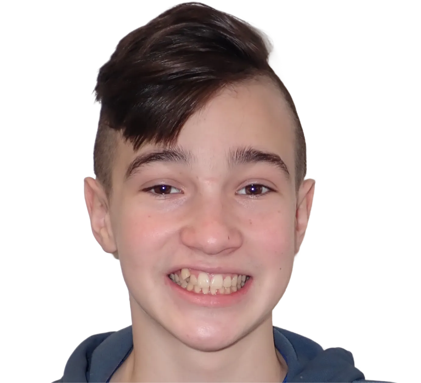 Before orthodontic treatment - Case 27