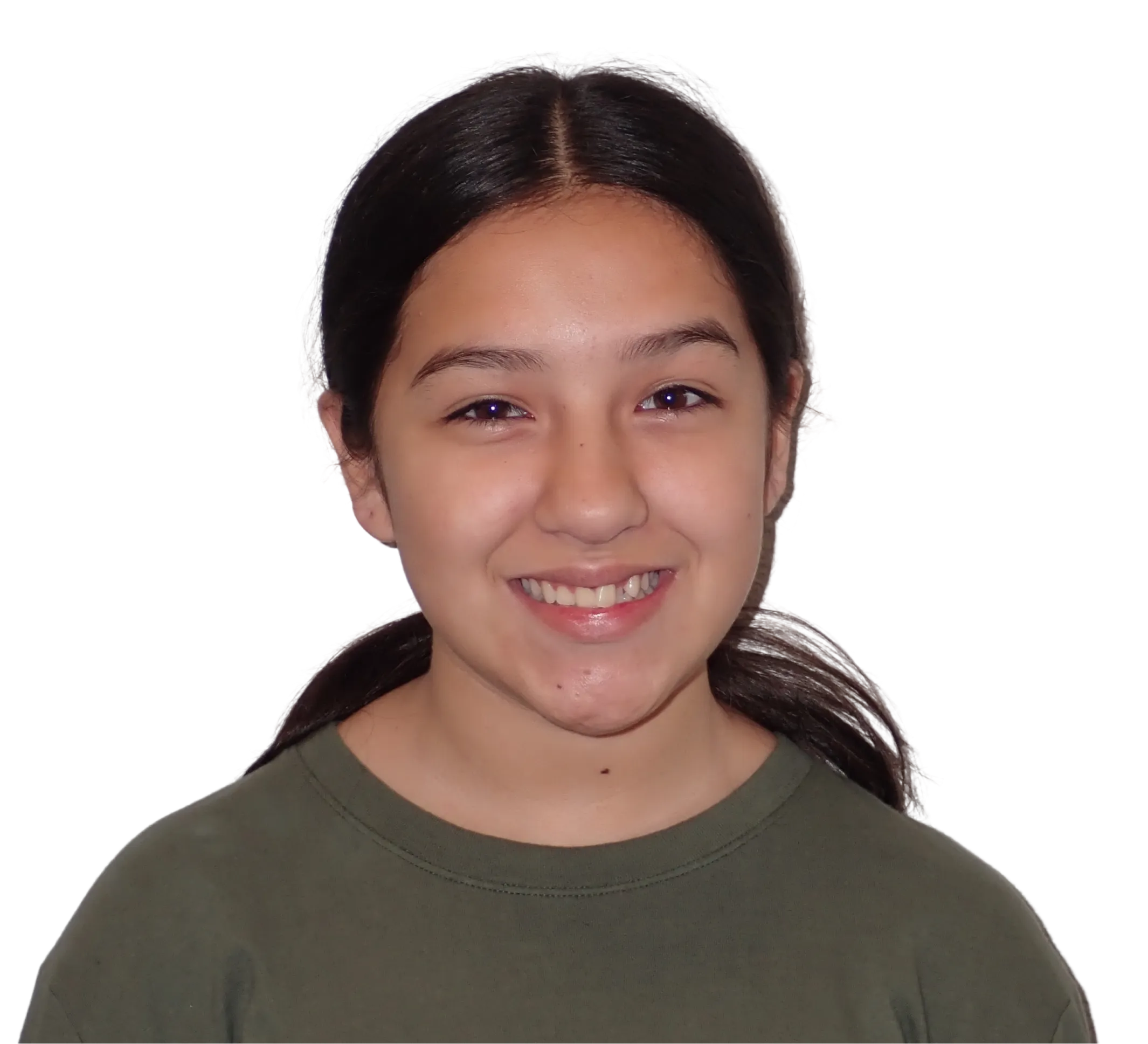 Before orthodontic treatment - Case 28