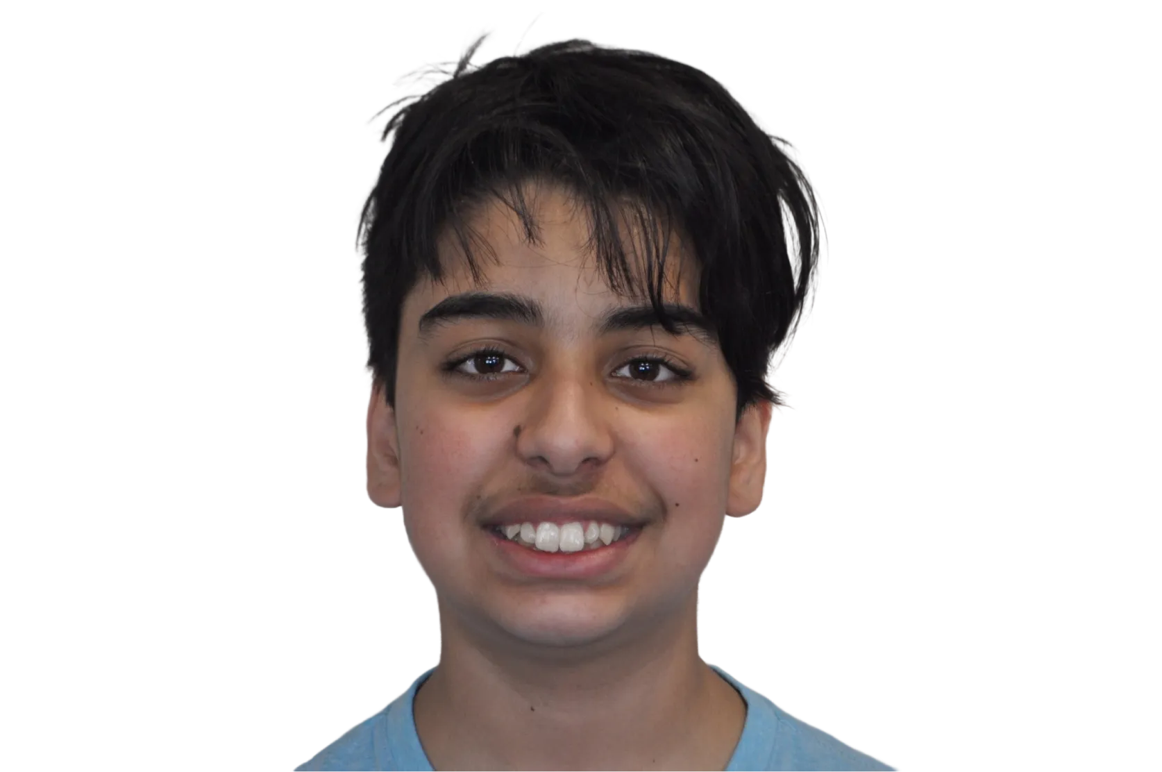 Before orthodontic treatment - Case 31