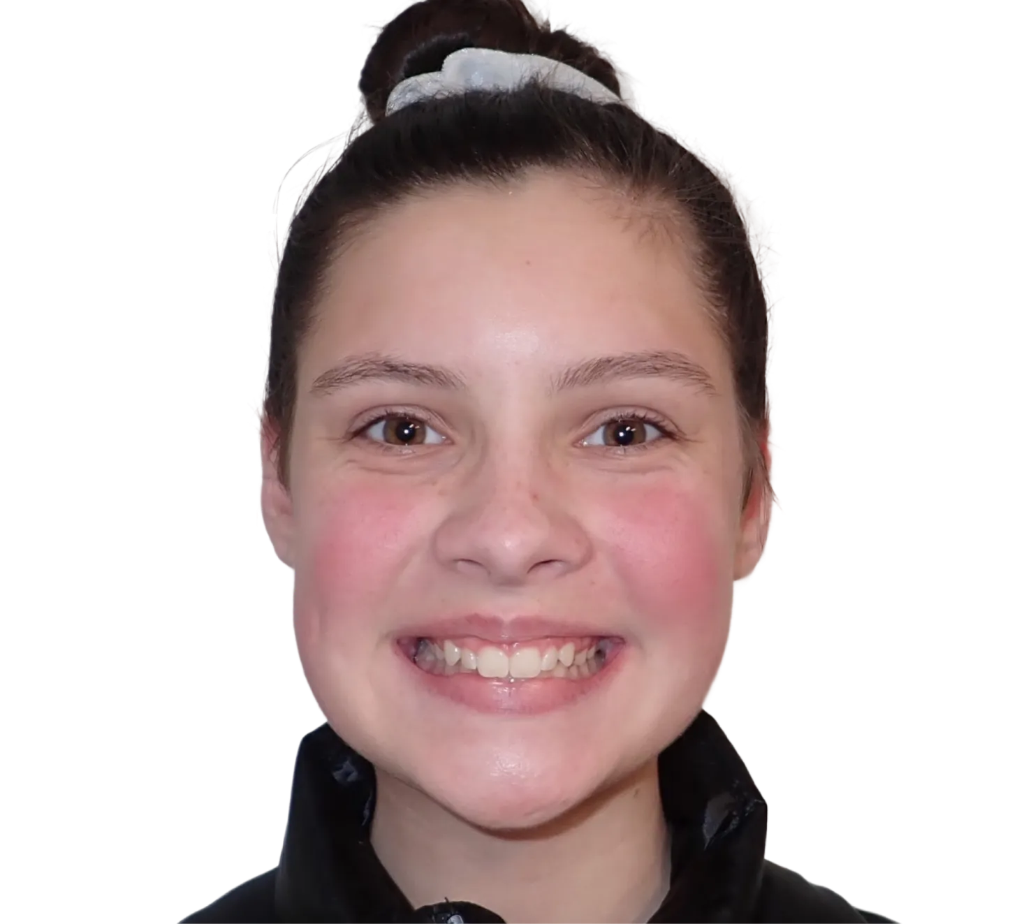 Before orthodontic treatment - Case 33
