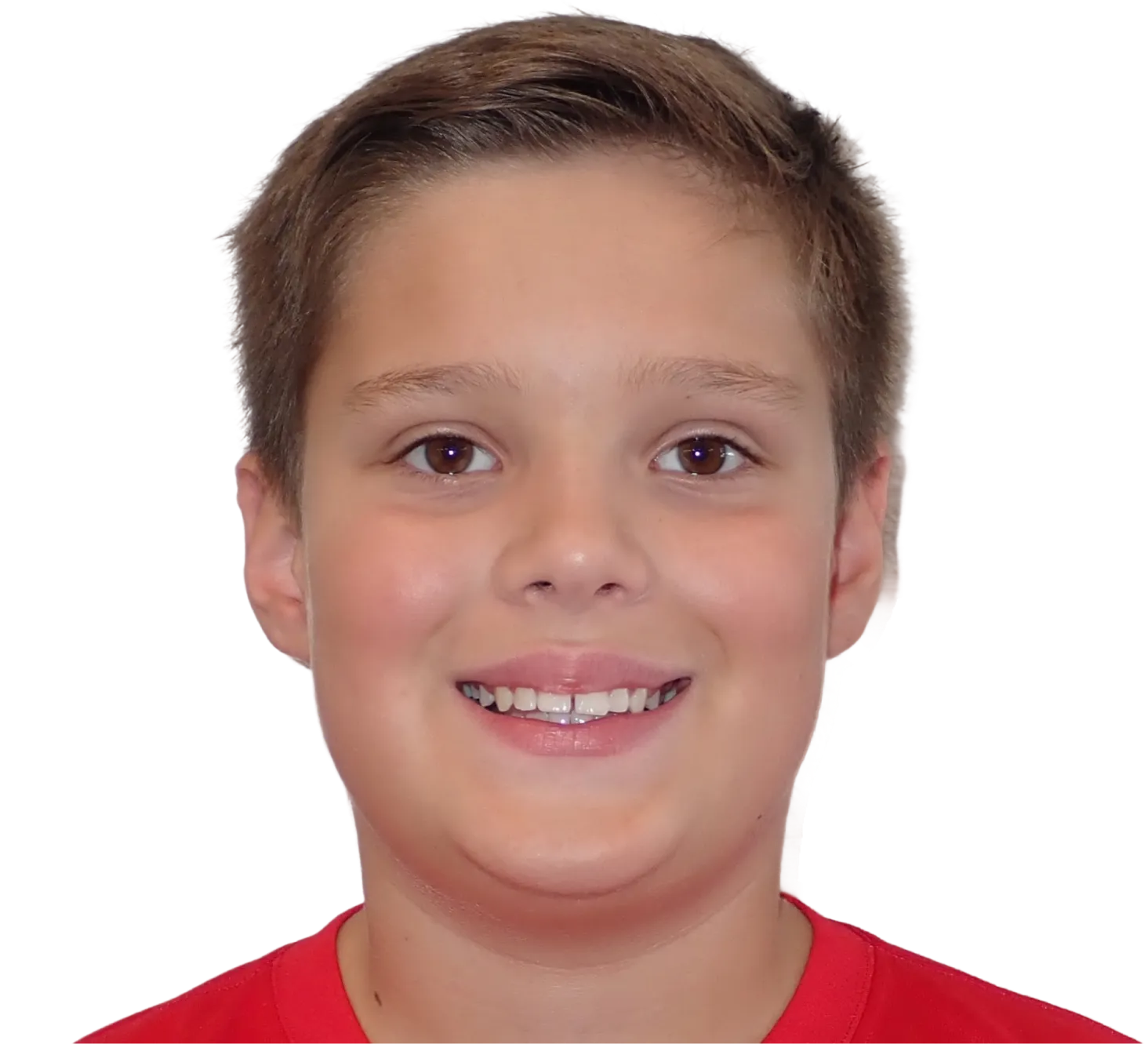 Before orthodontic treatment - Case 35