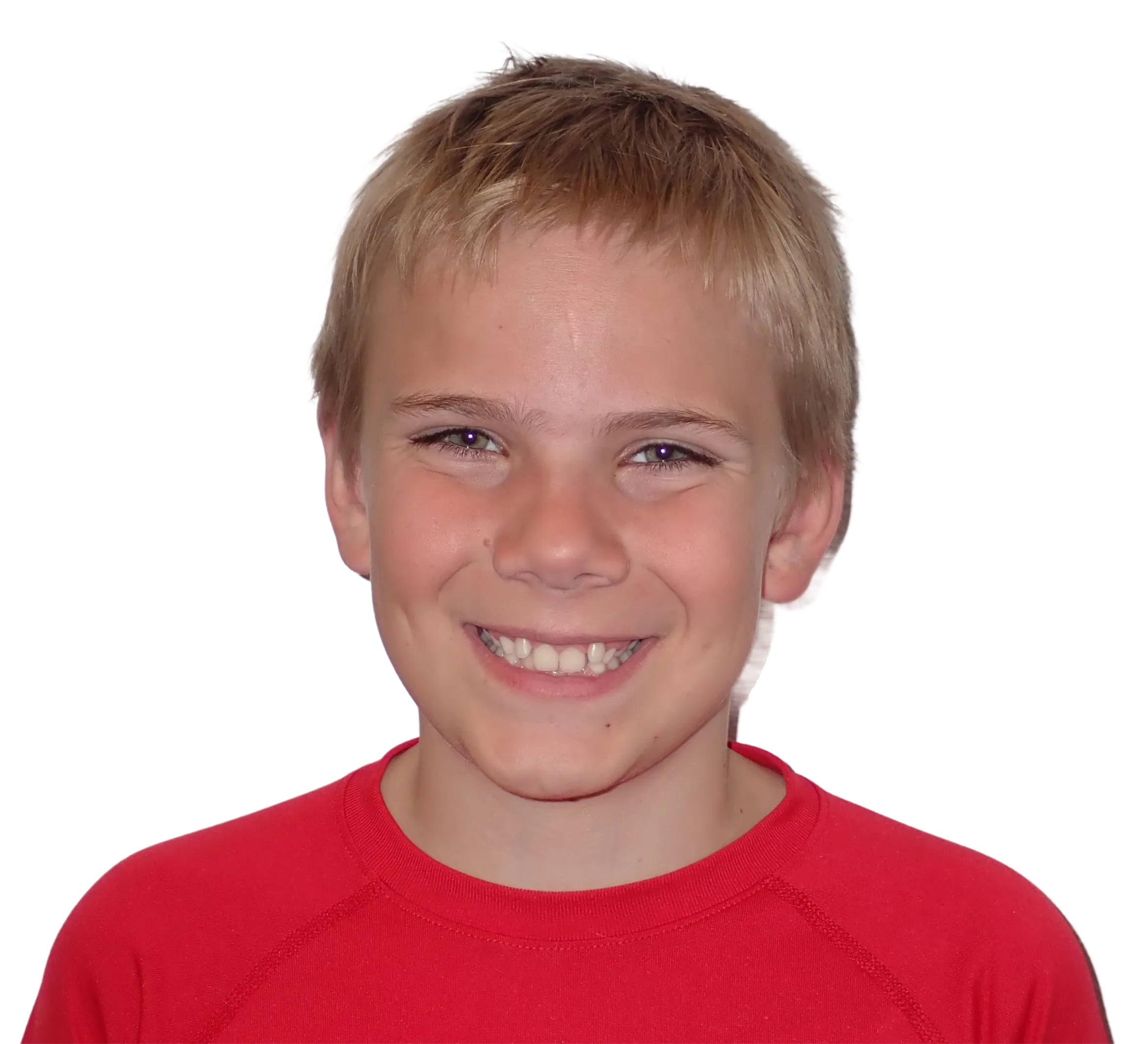 Before orthodontic treatment - Case 36