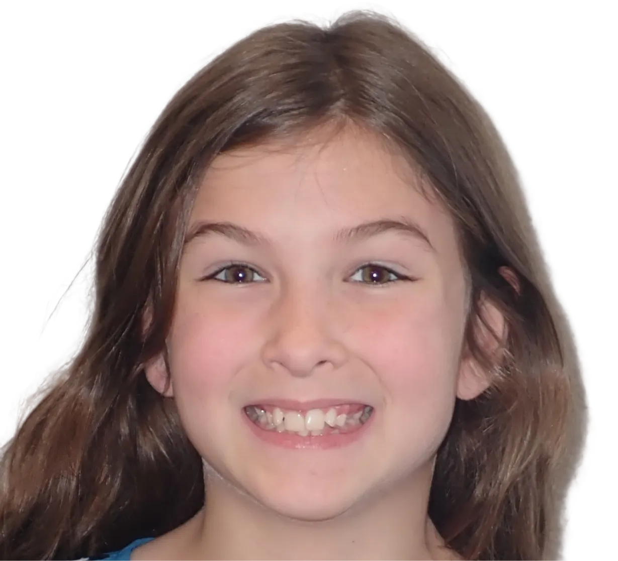 Before orthodontic treatment - Case 37