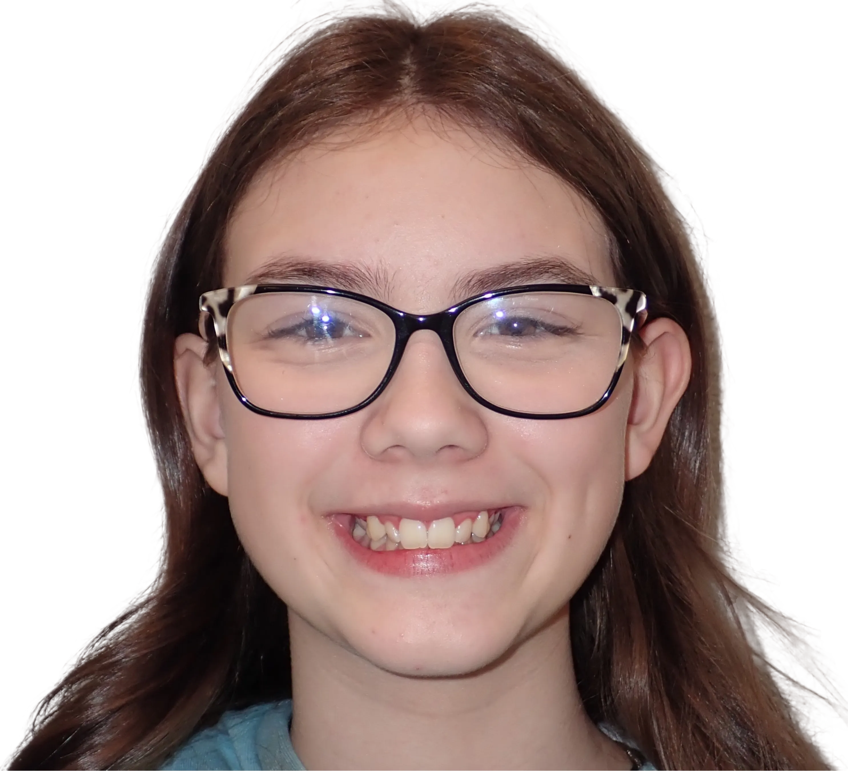 Before orthodontic treatment - Case 38