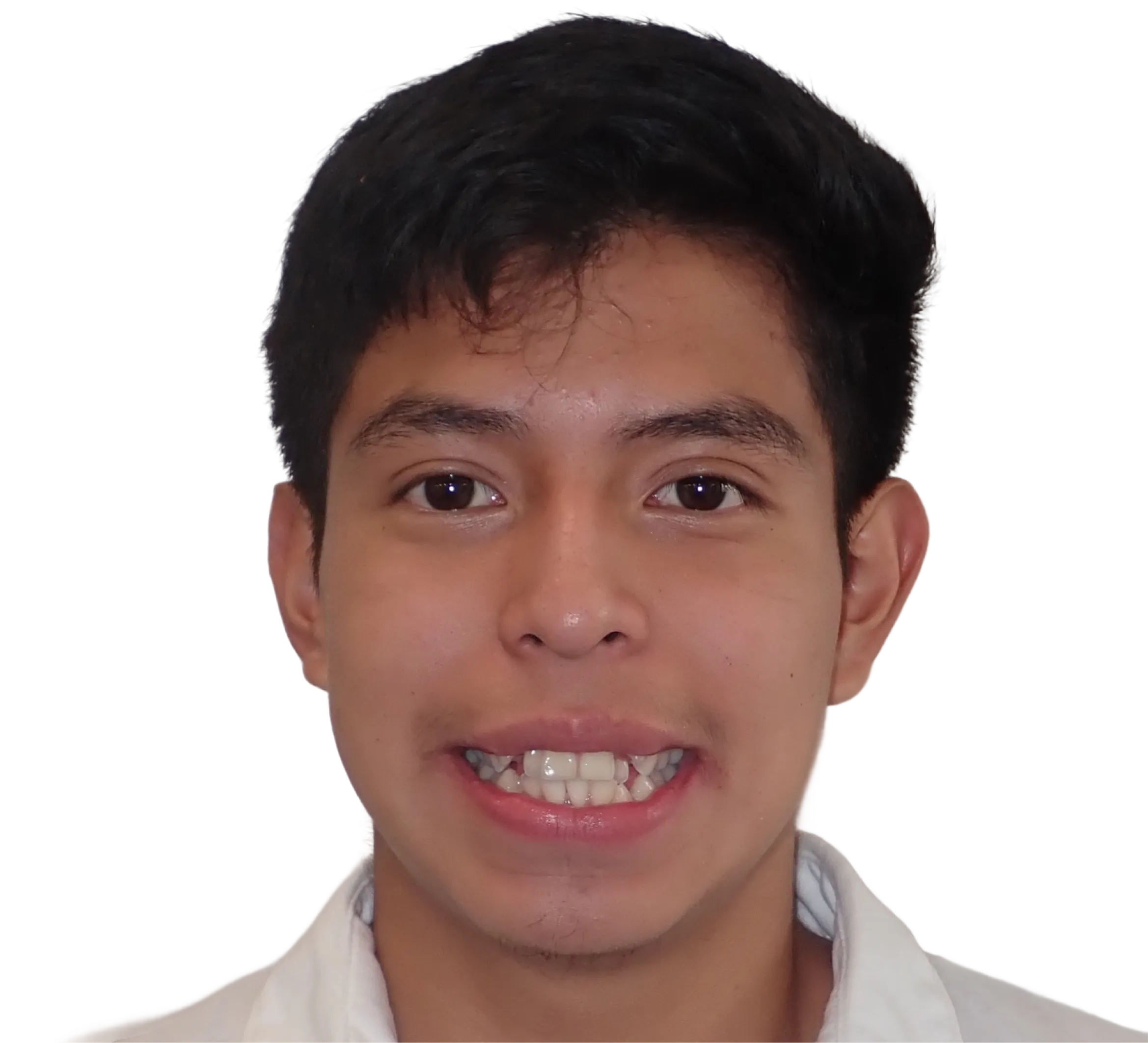 Before orthodontic treatment - Case 13