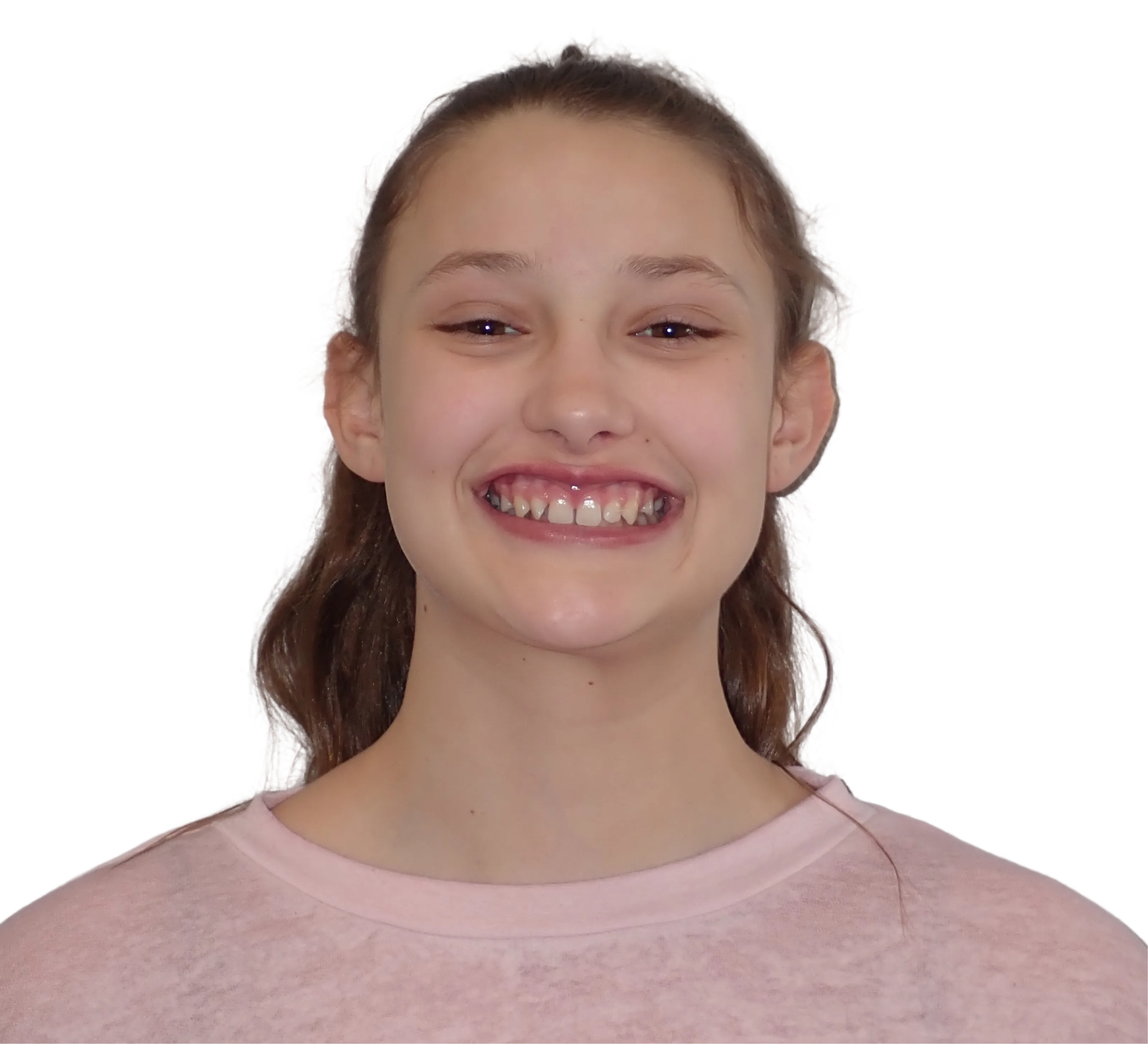 Before orthodontic treatment - Case 42