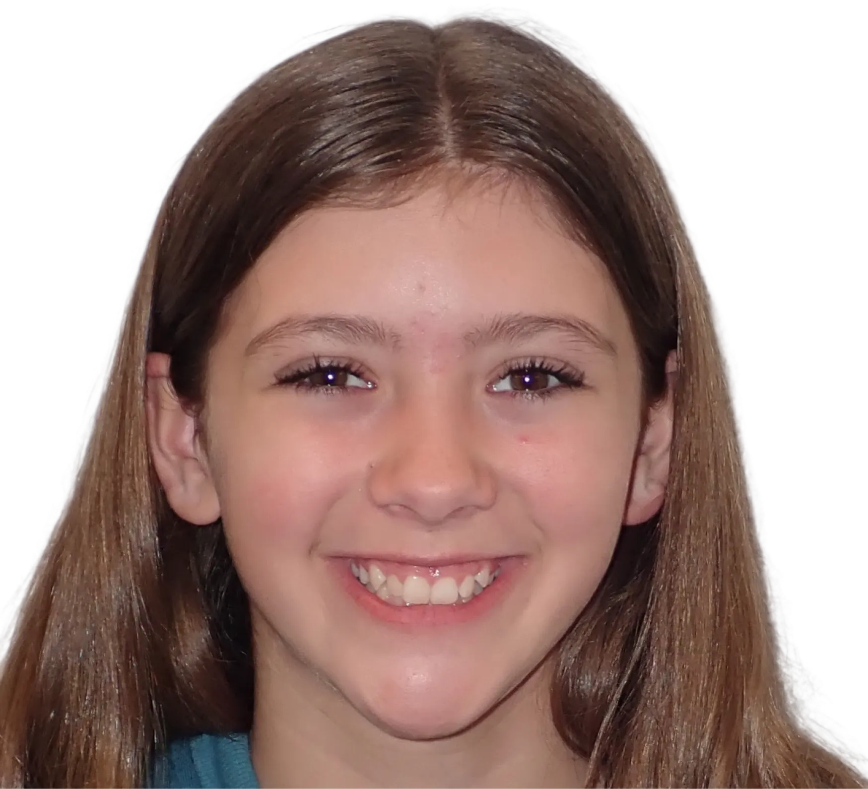 Before orthodontic treatment - Case 44