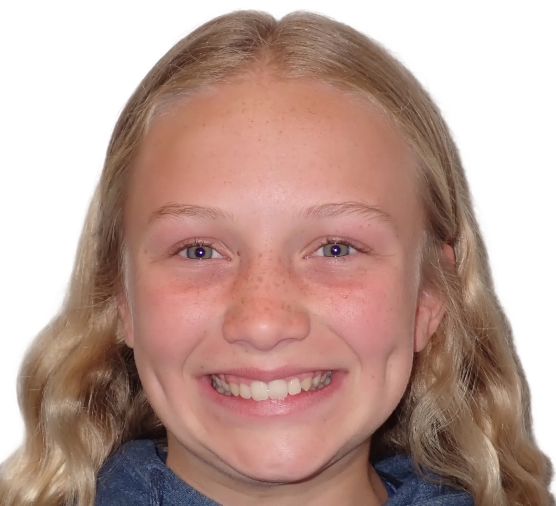 Before orthodontic treatment - Case 45