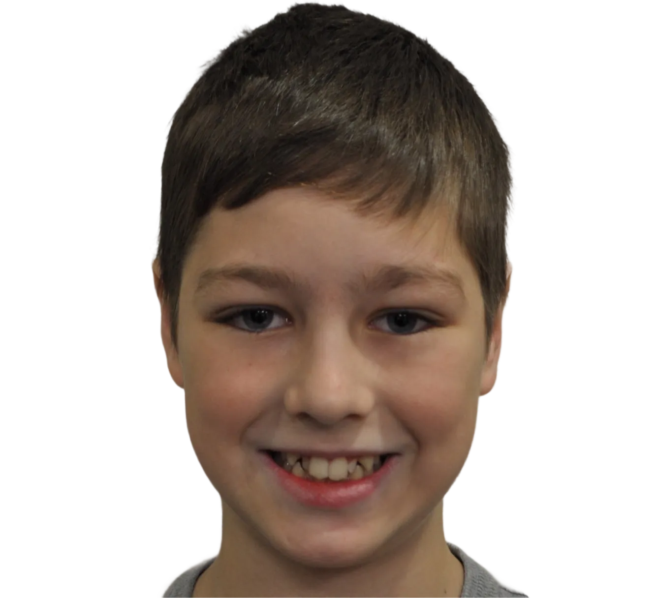 Before orthodontic treatment - Case 47