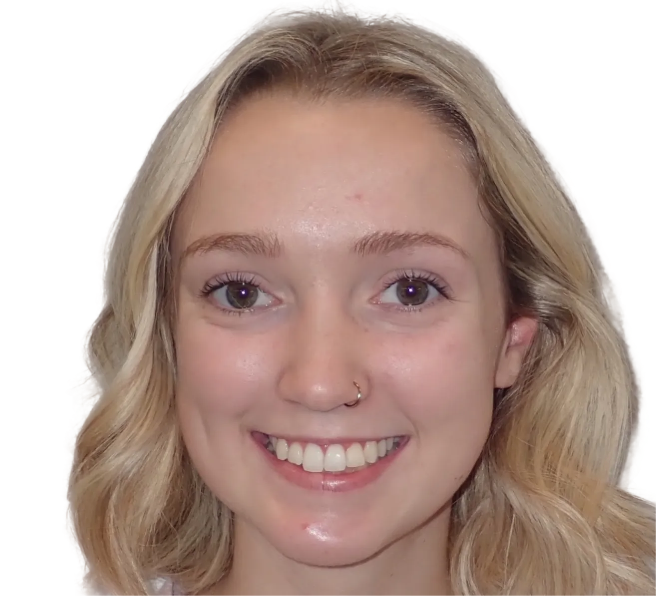 Before orthodontic treatment - Case 49