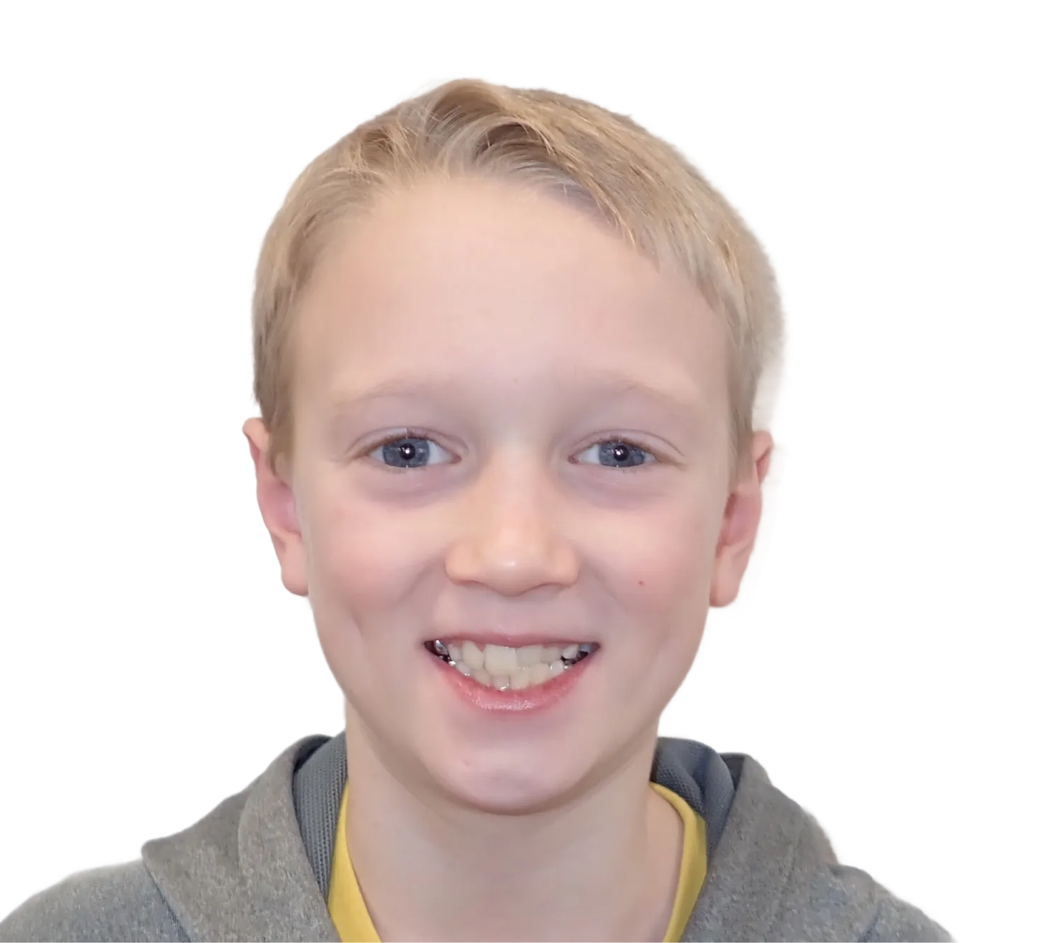 Before orthodontic treatment - Case 50
