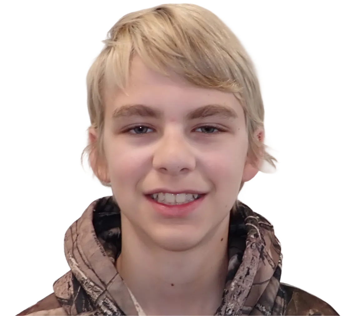 Before orthodontic treatment - Case 51