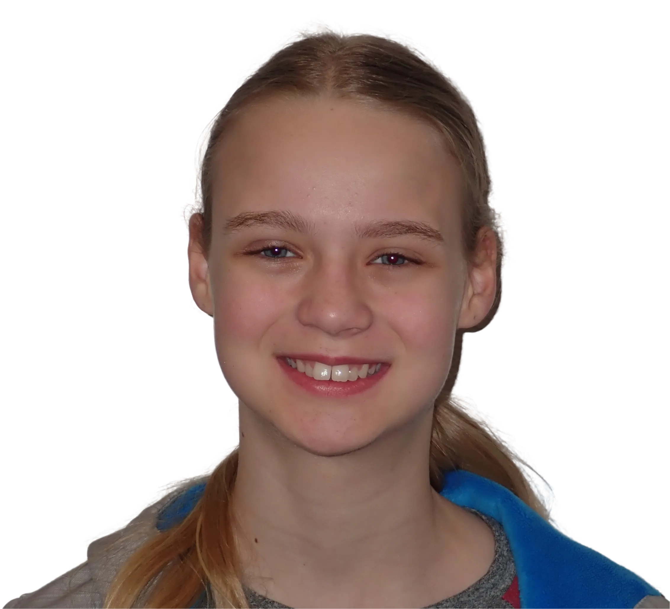 Before orthodontic treatment - Case 52