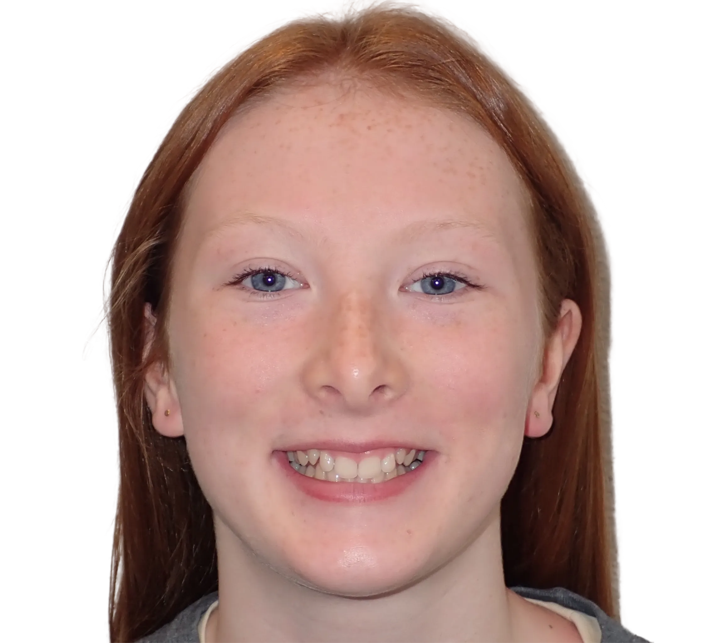 Before orthodontic treatment - Case 53