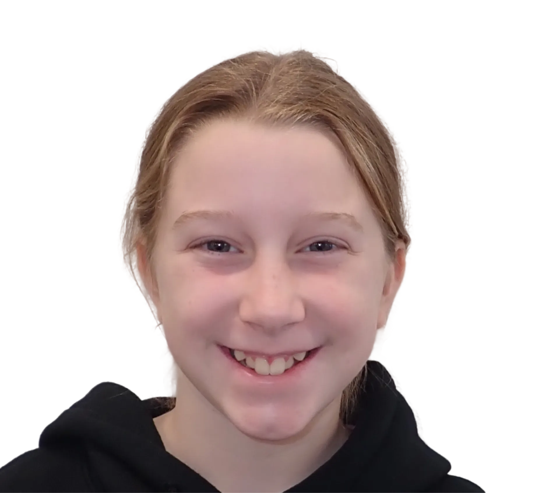 Before orthodontic treatment - Case 14
