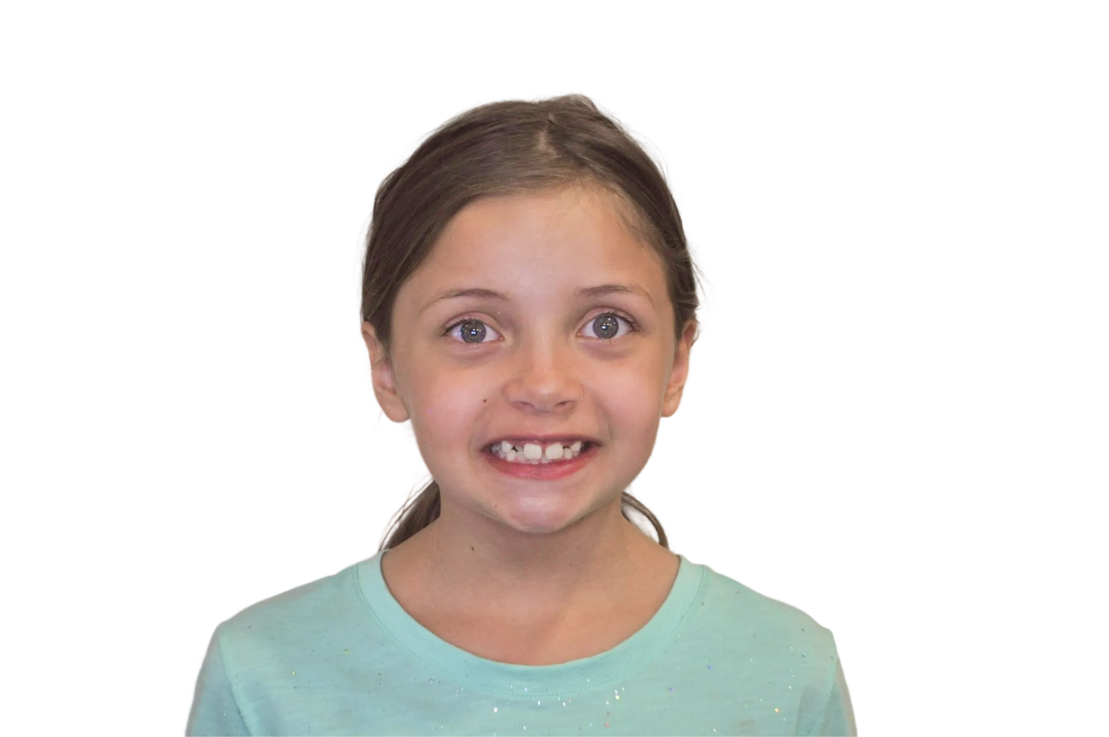 Before orthodontic treatment - Case 55