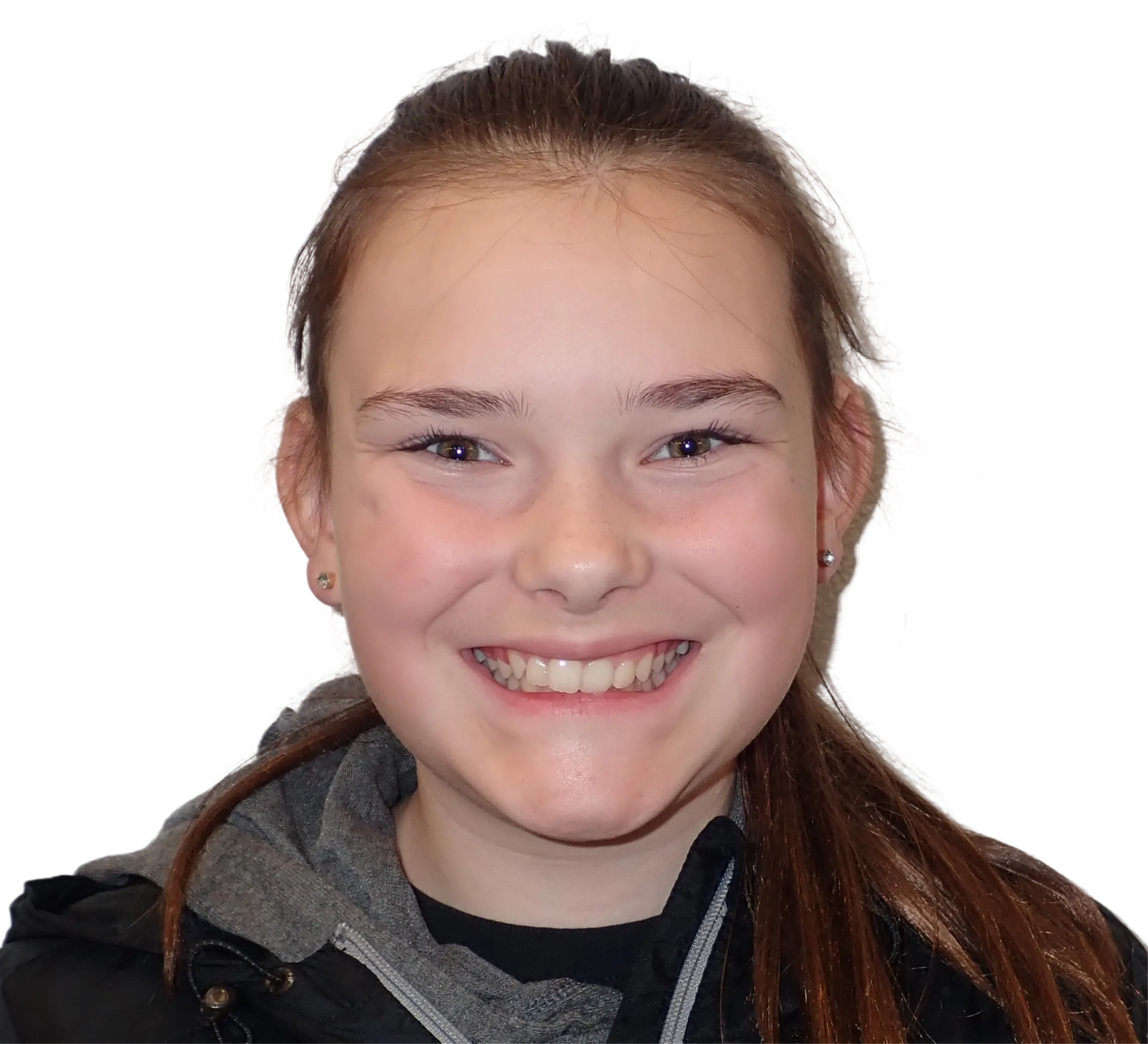 Before orthodontic treatment - Case 58