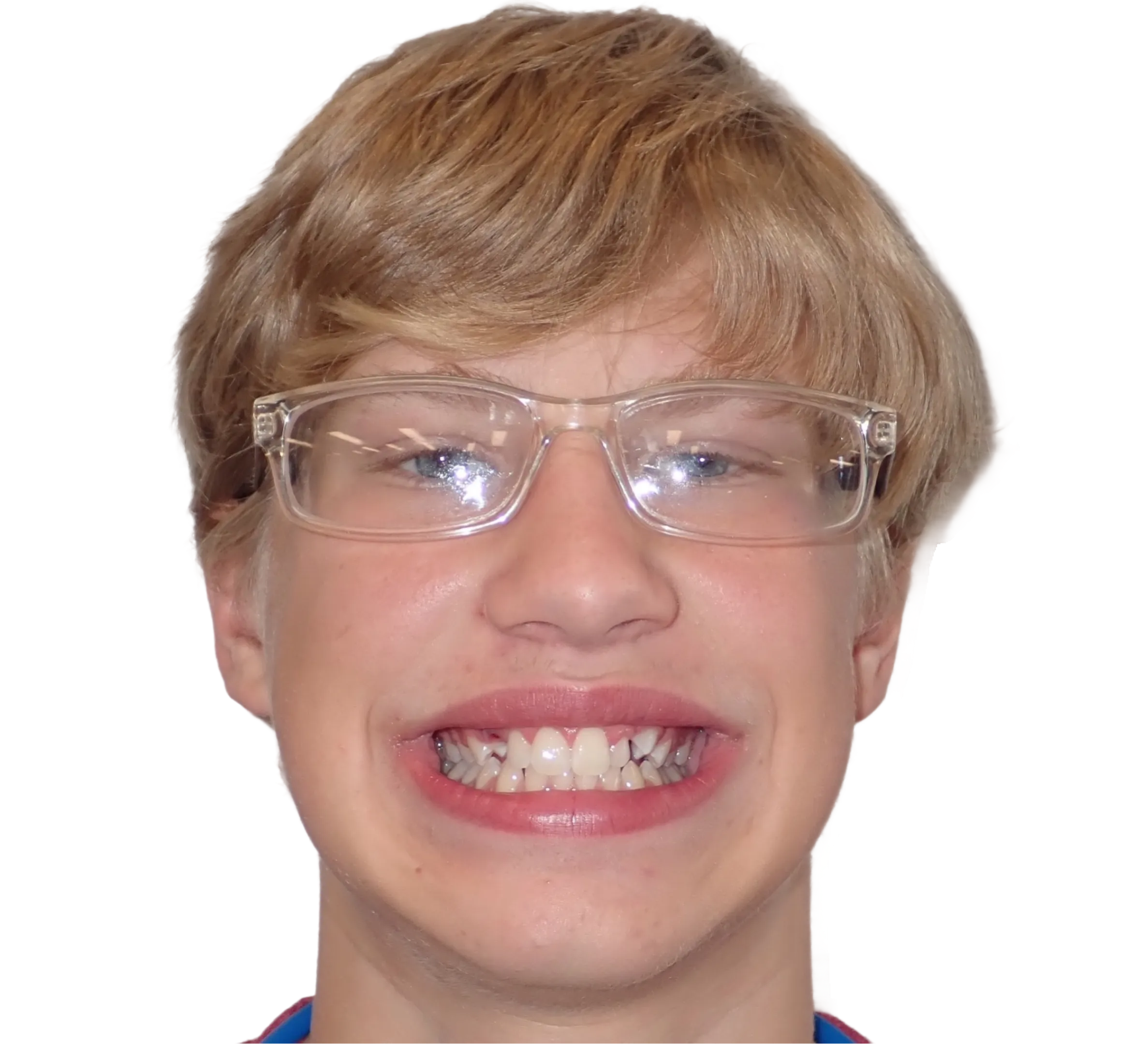 Before orthodontic treatment - Case 59